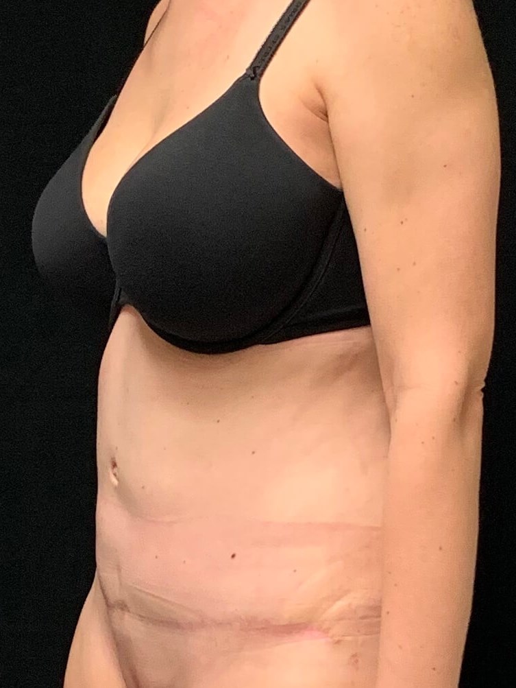 Abdominoplasty / Tummy Tuck After Abdominoplasty / Tummy Tuck After