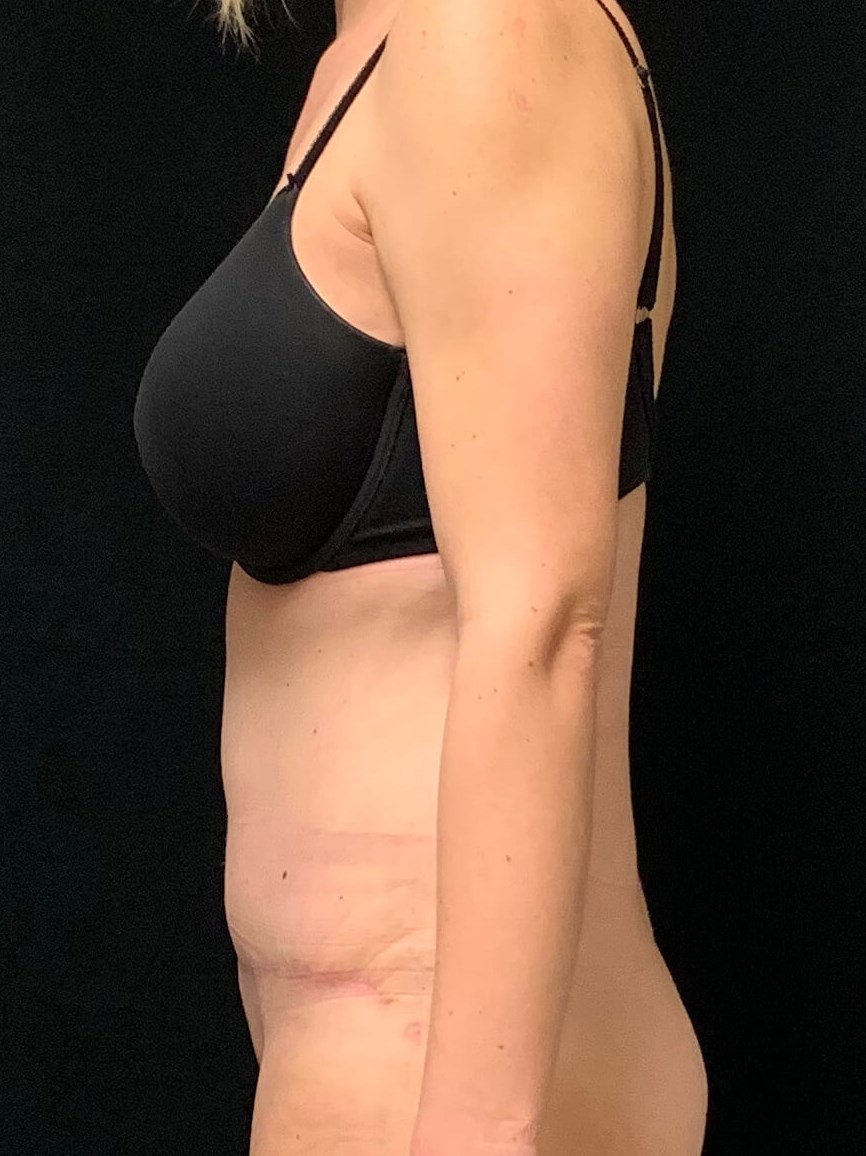 Abdominoplasty / Tummy Tuck After Abdominoplasty / Tummy Tuck After