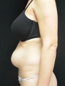 Abdominoplasty / Tummy Tuck Before Abdominoplasty / Tummy Tuck Before