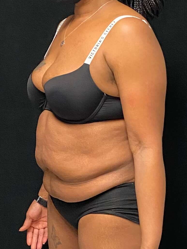 Abdominoplasty Liposuction Before Abdominoplasty Liposuction Before