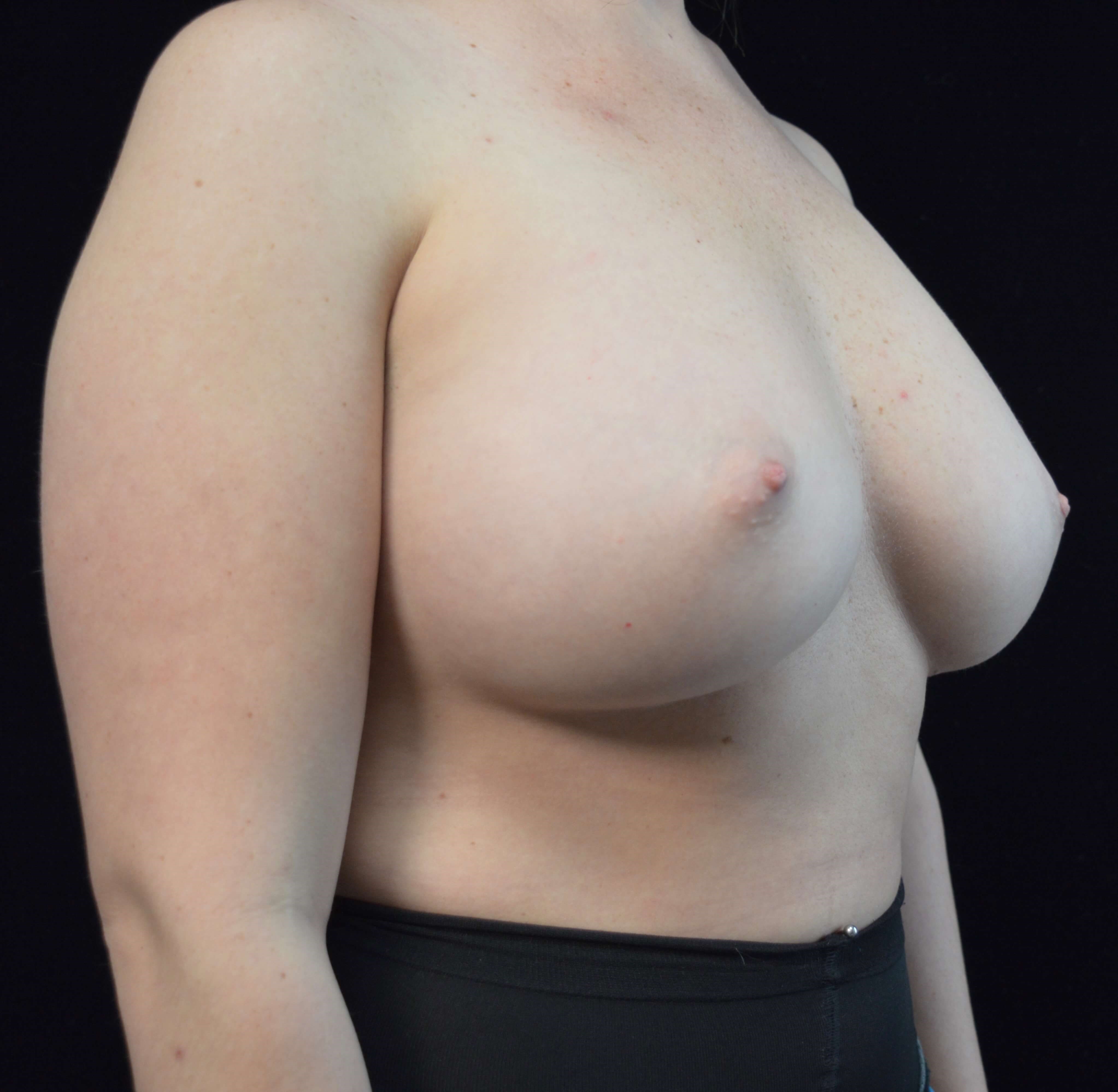 Before and After After