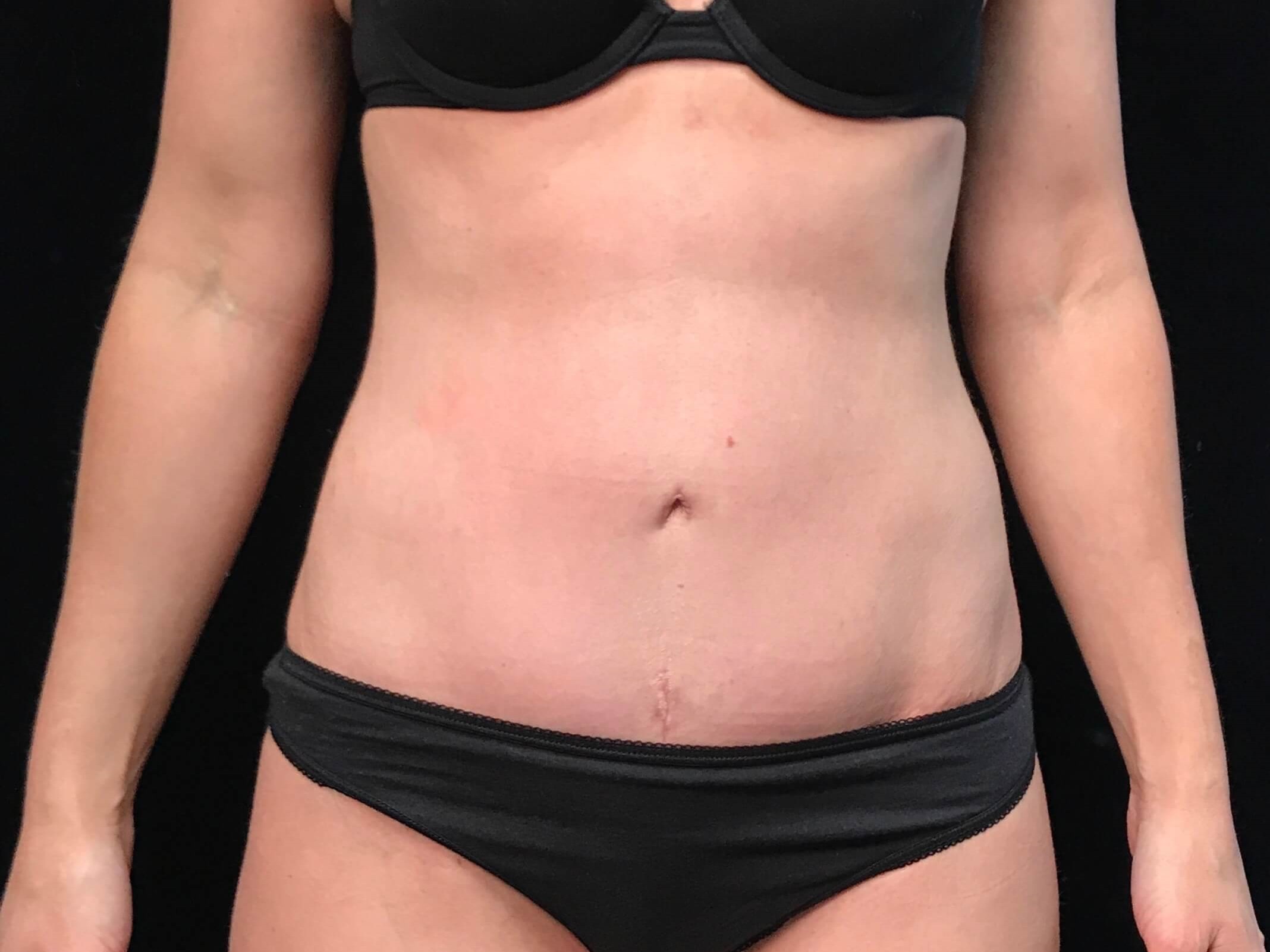 Before and After After