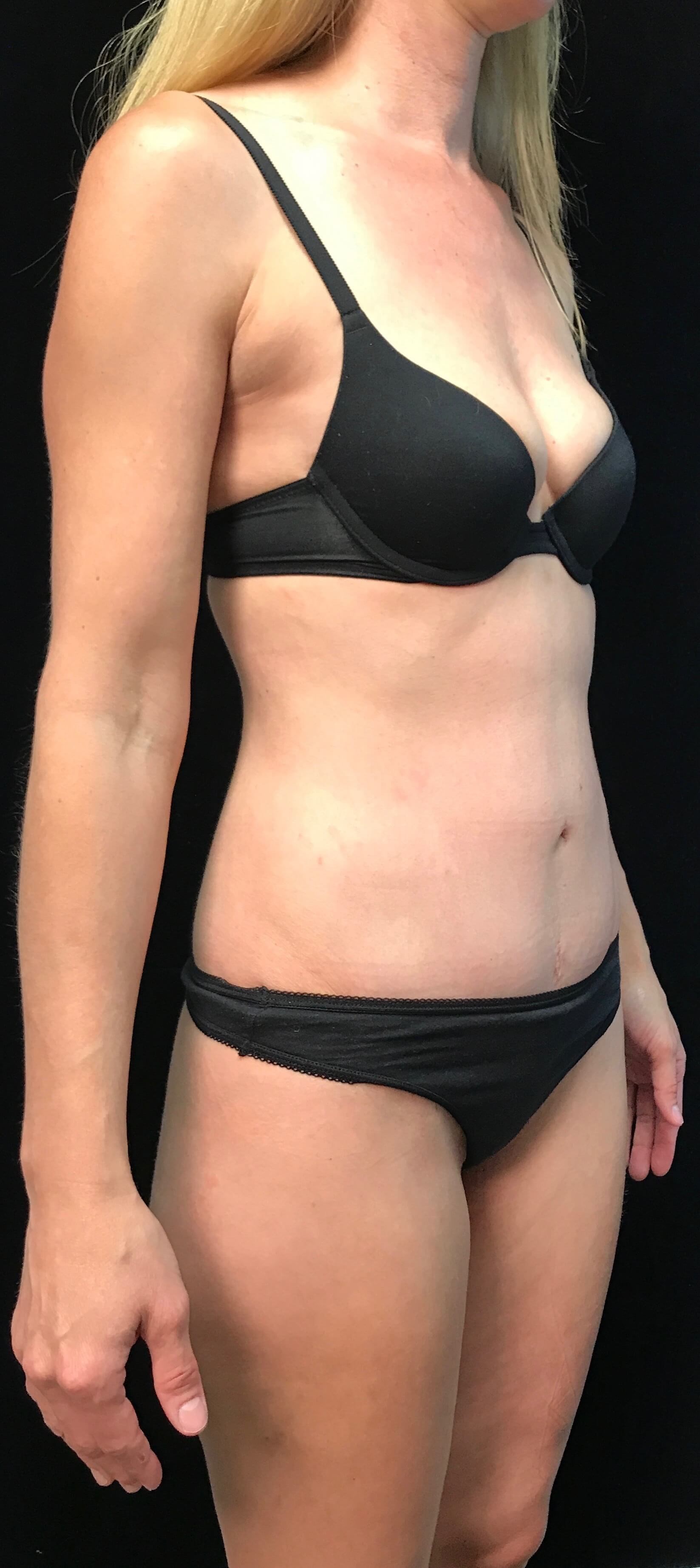 Before and After After