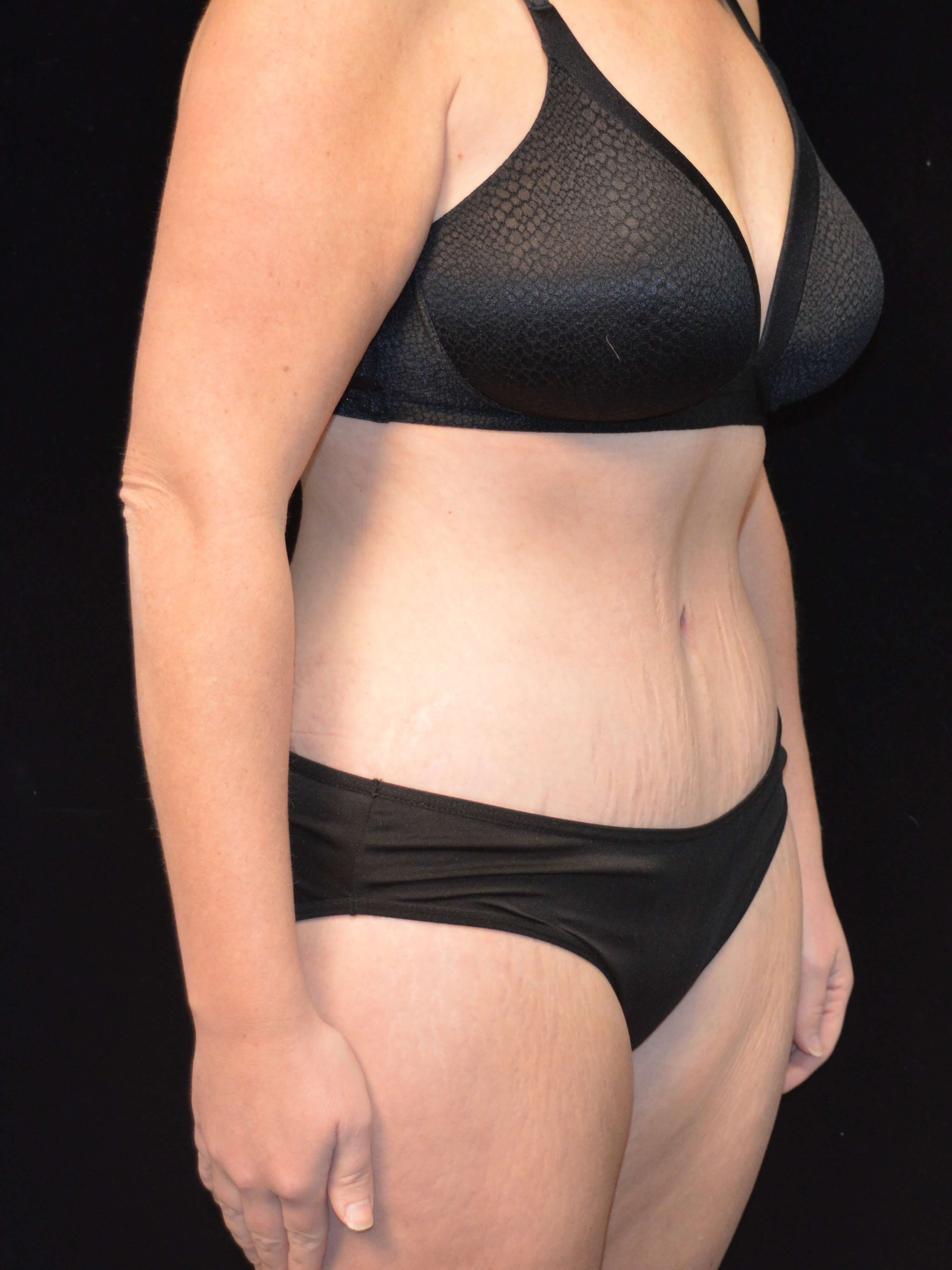 Before and After After