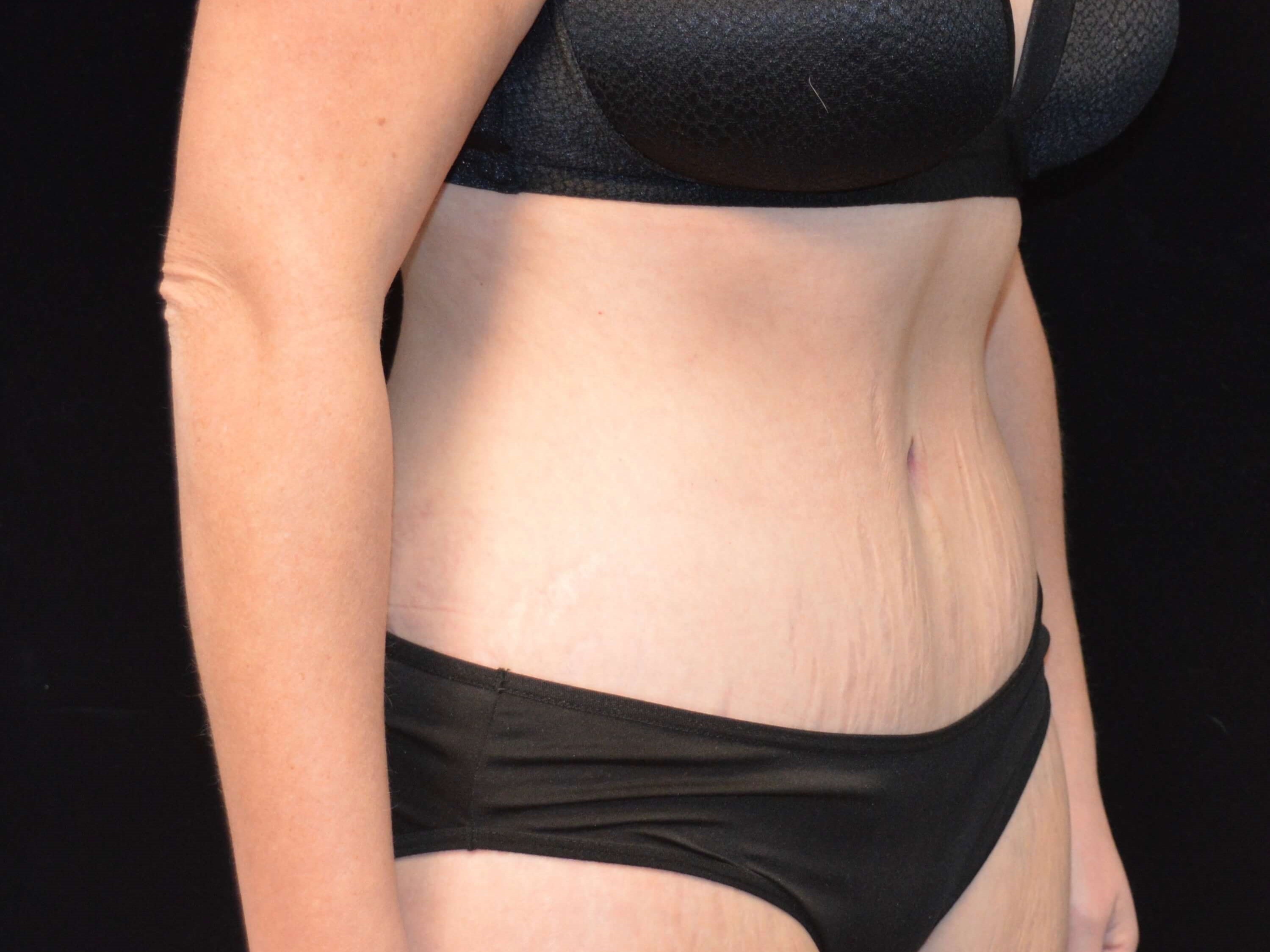 Before and After After