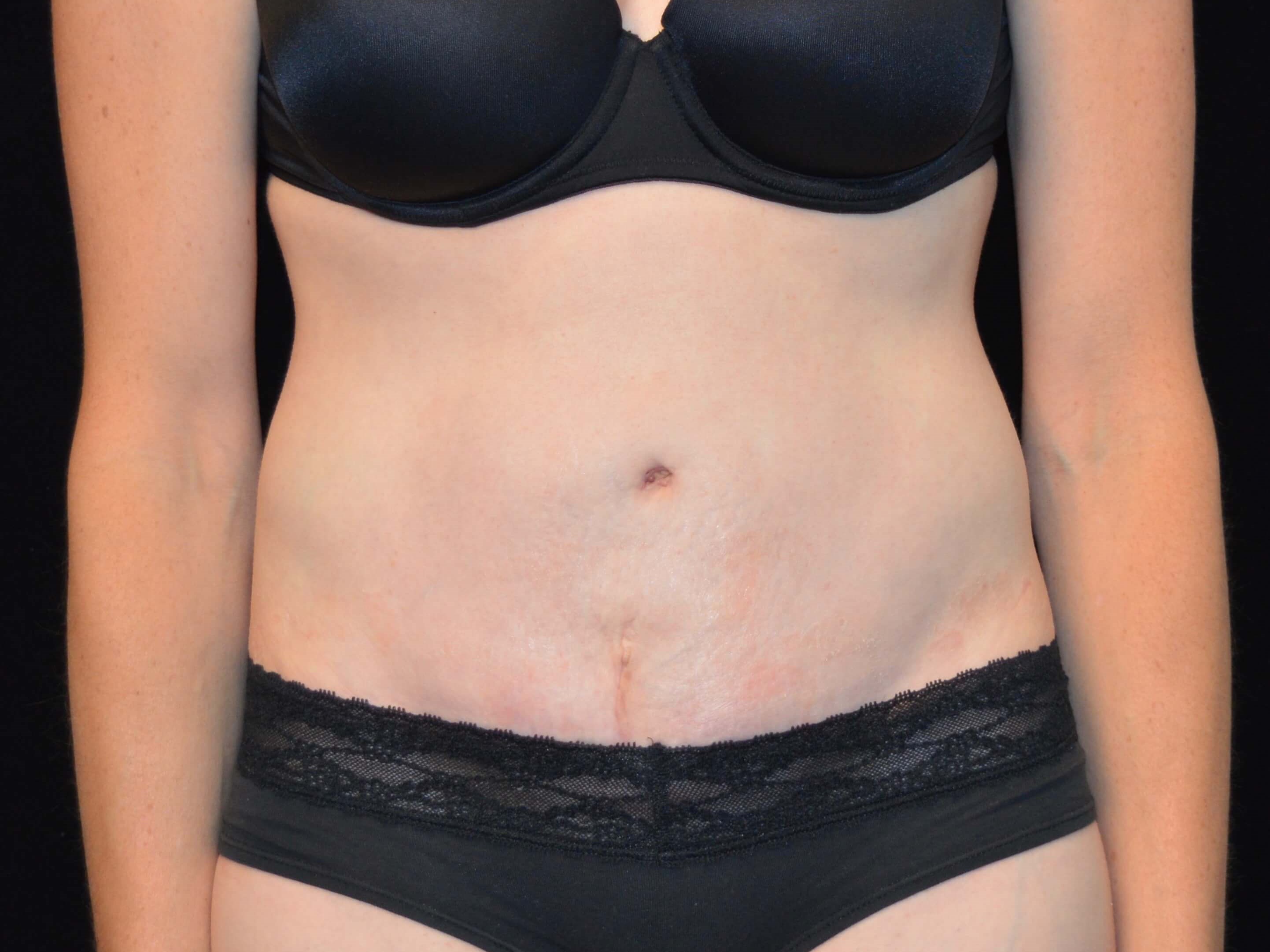 Before and After After