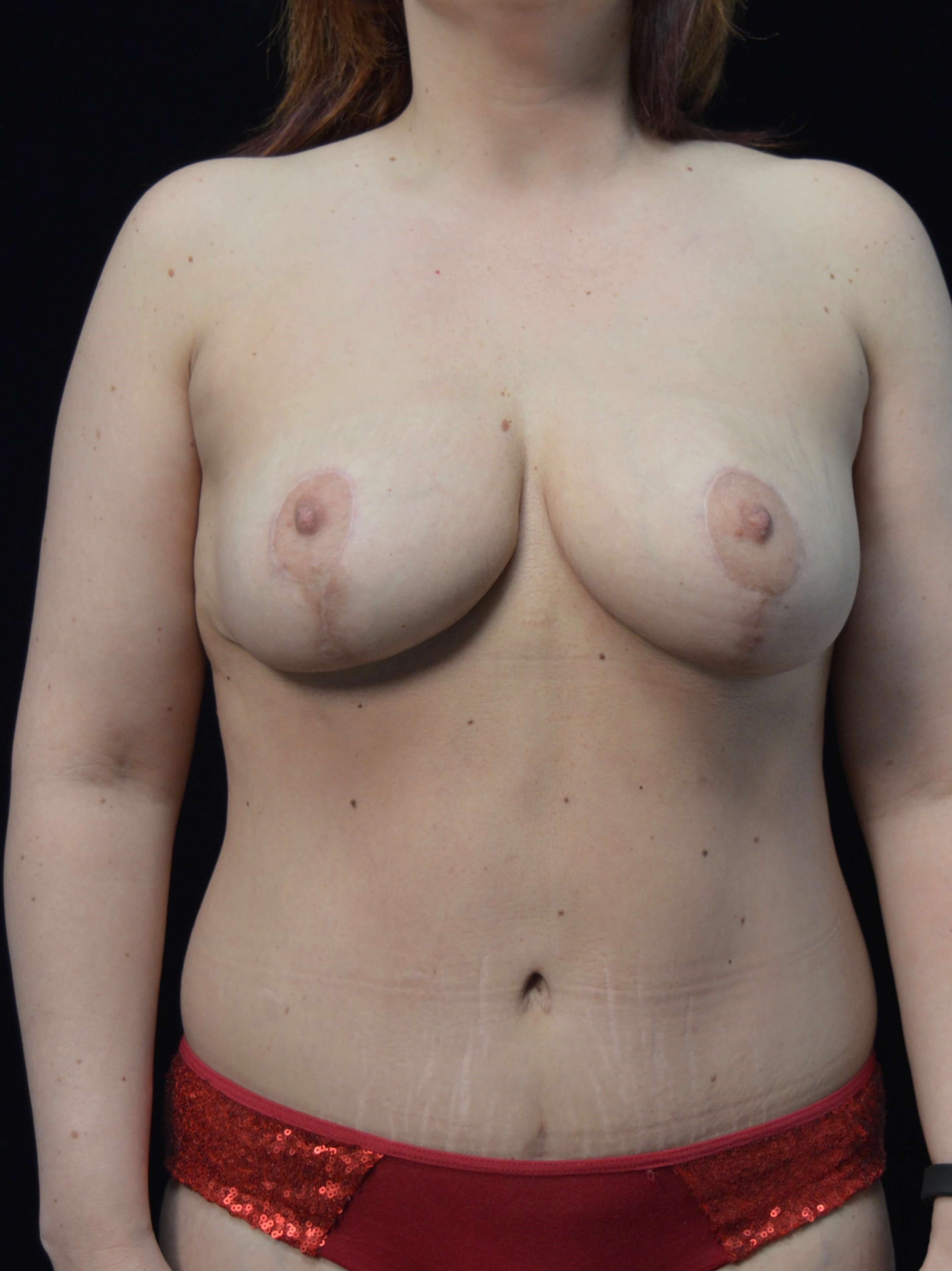 Before and After After