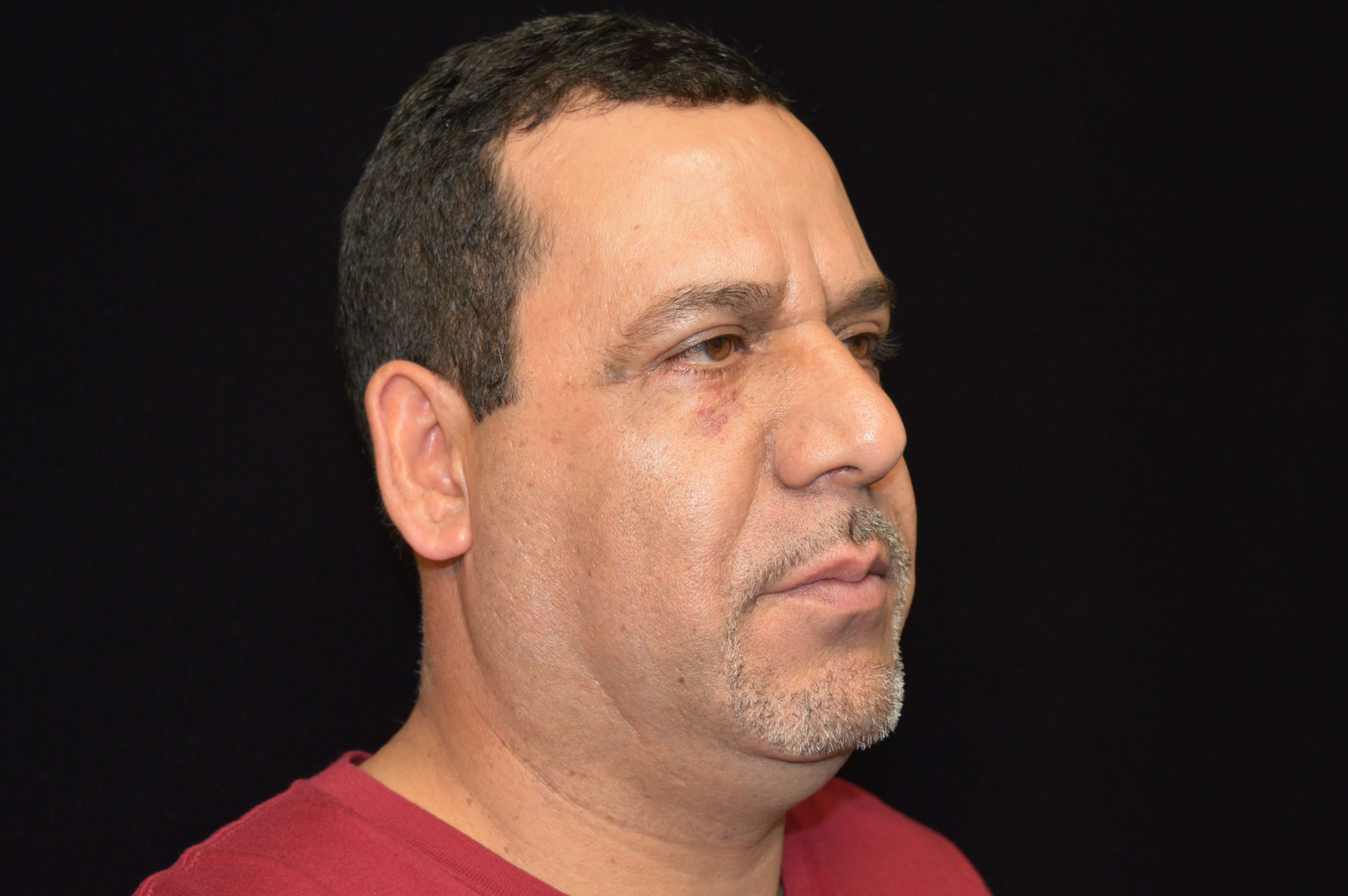 Before and After After