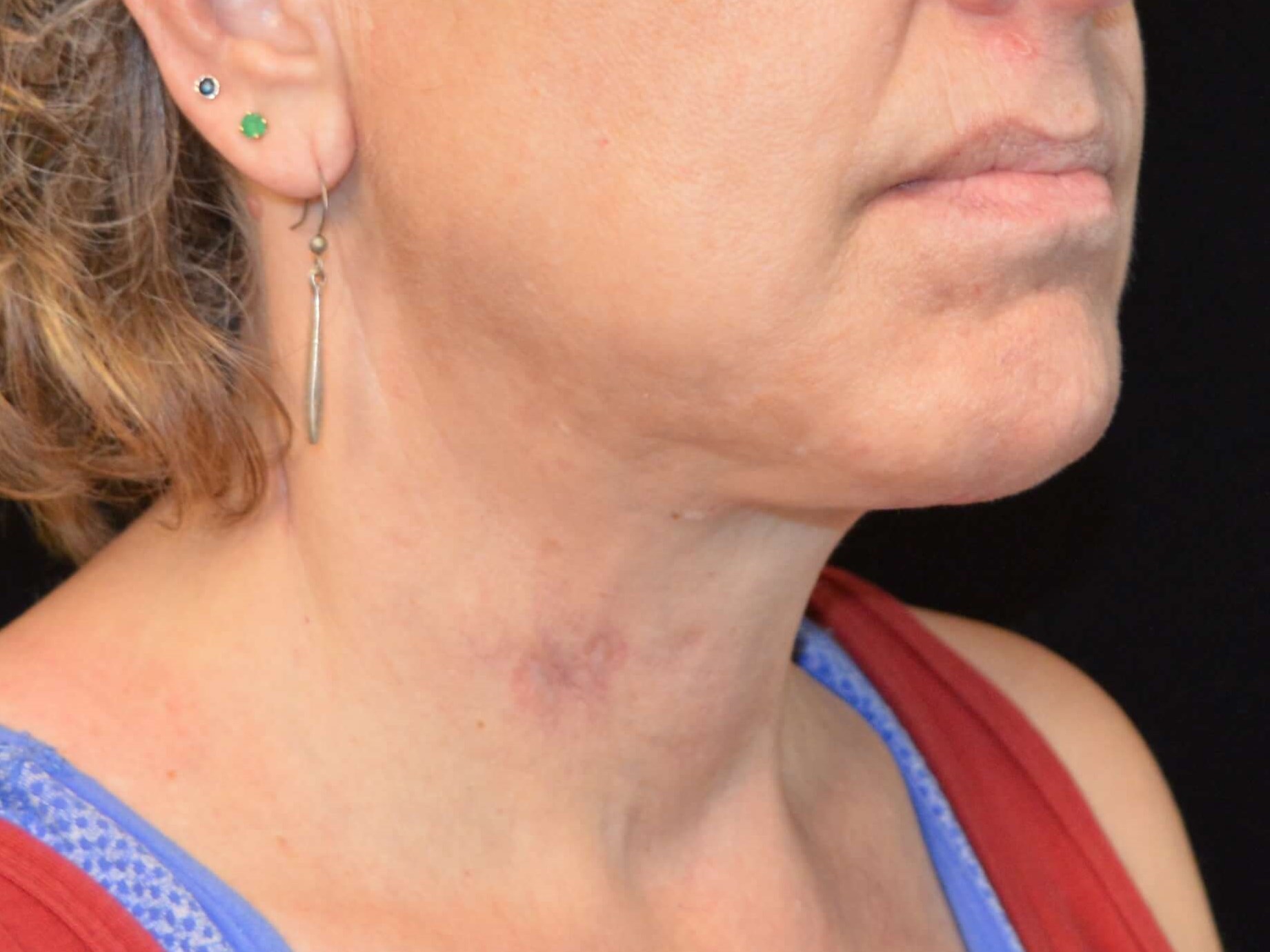 Before and After After