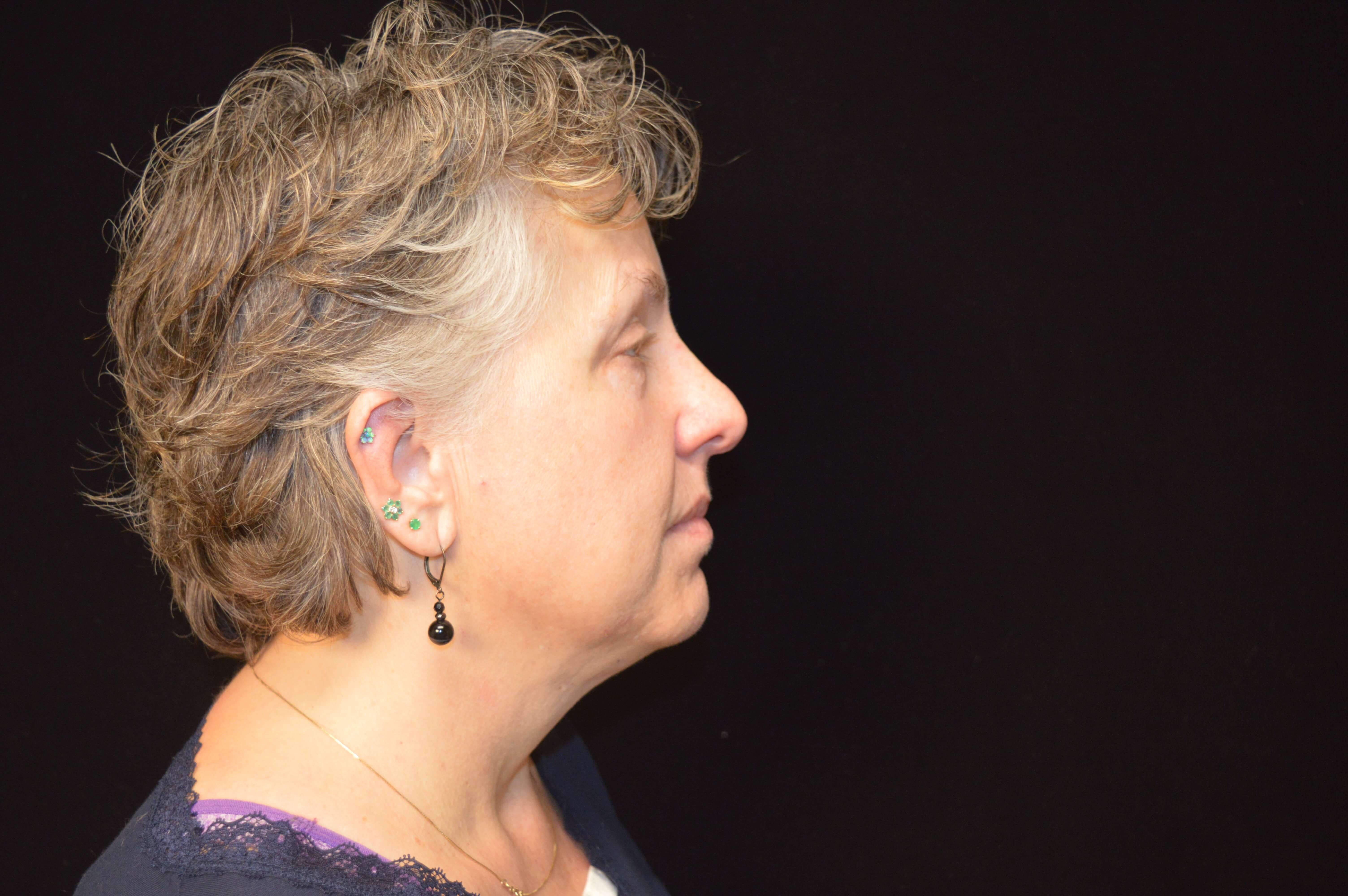 Before and After Before