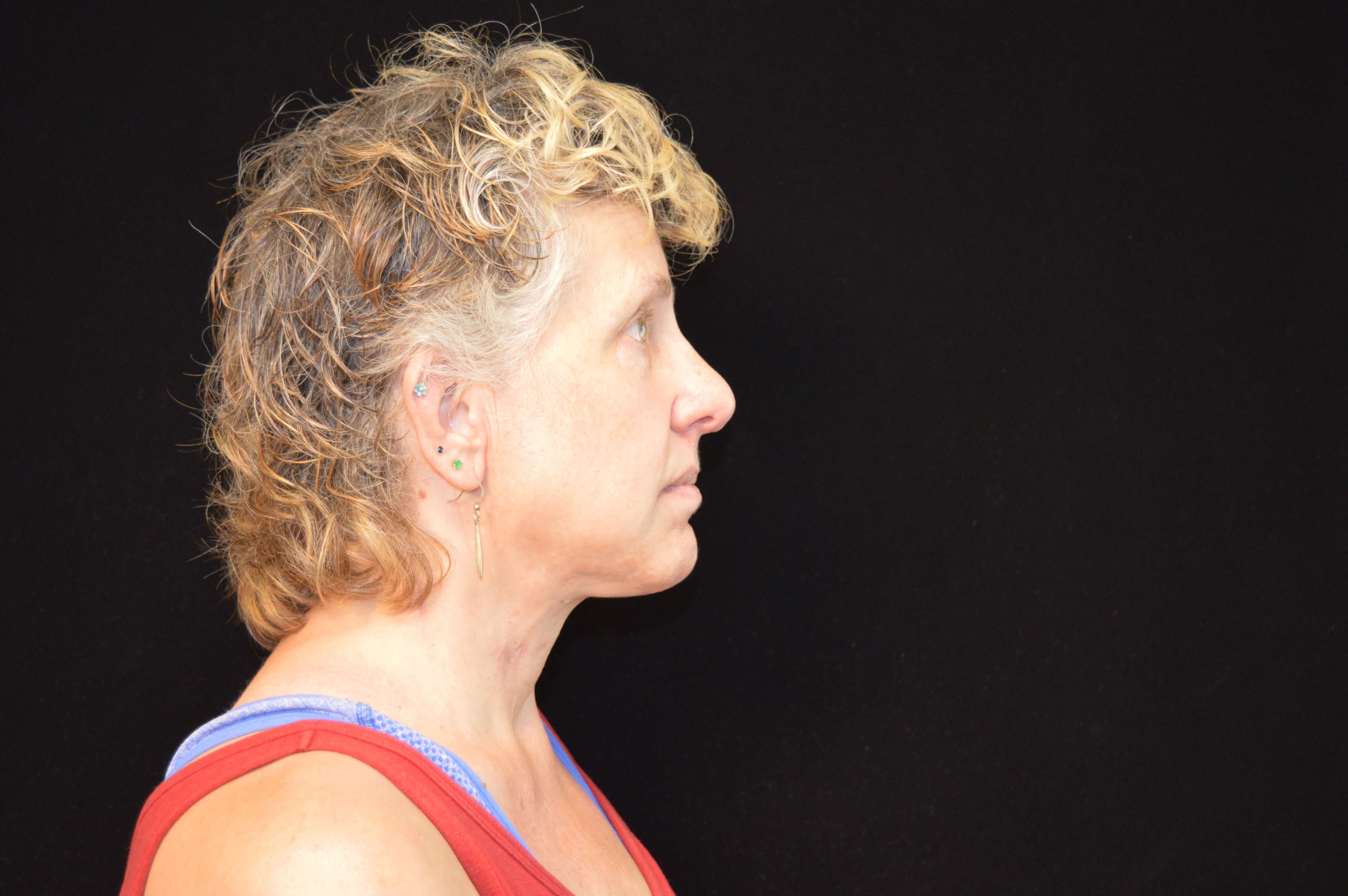 Before and After After