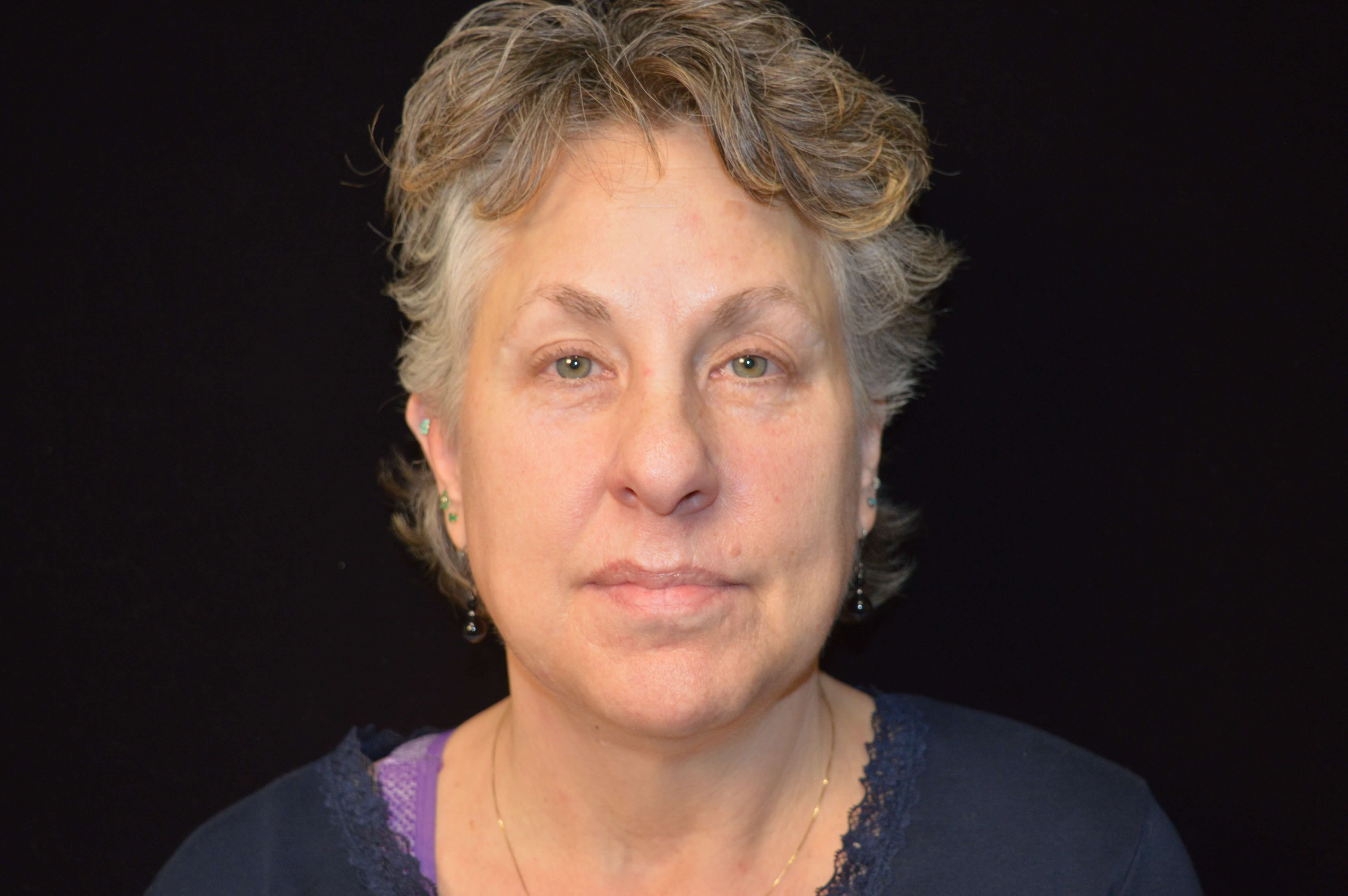 Before and After Before