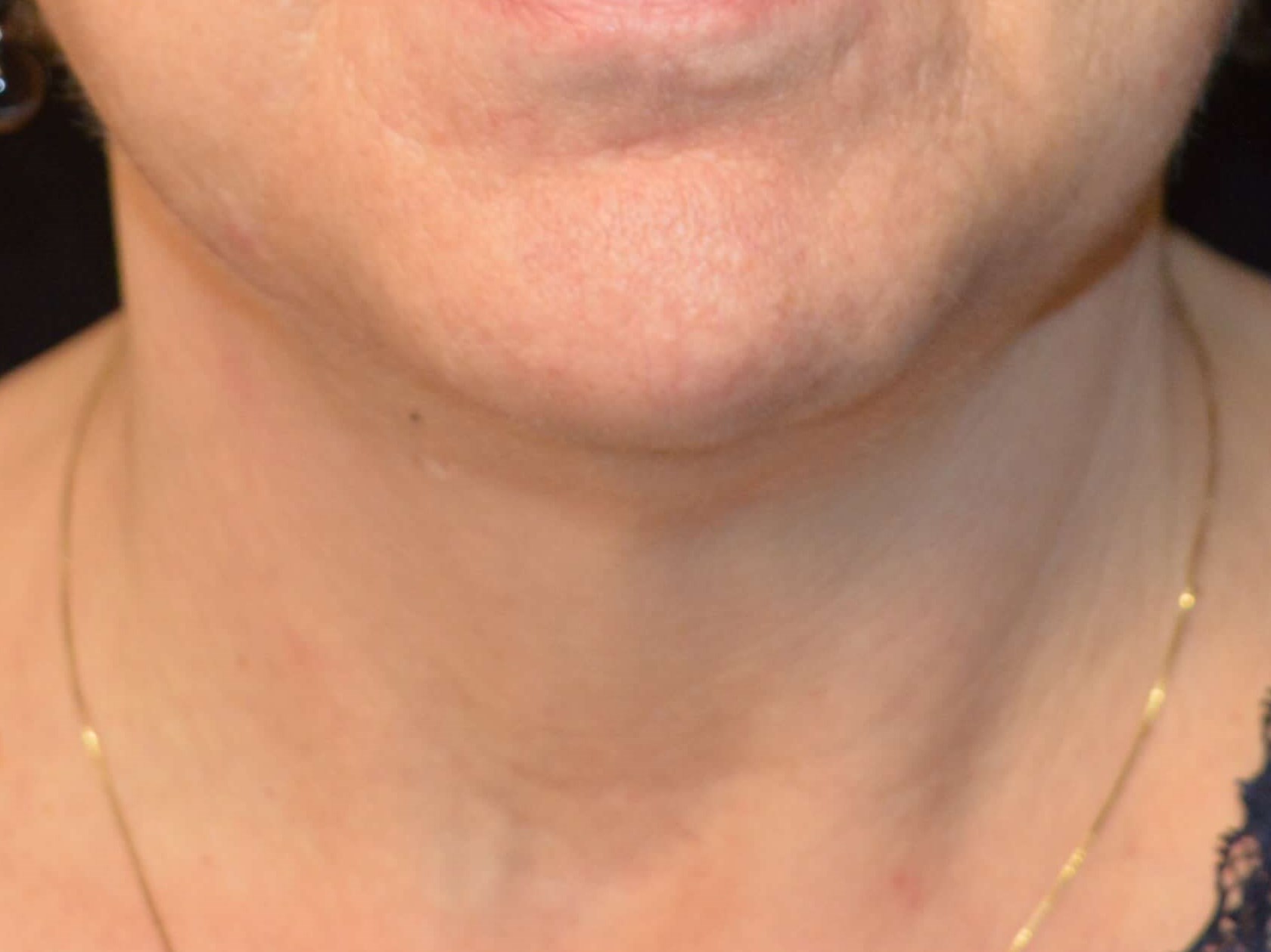 Before and After Before