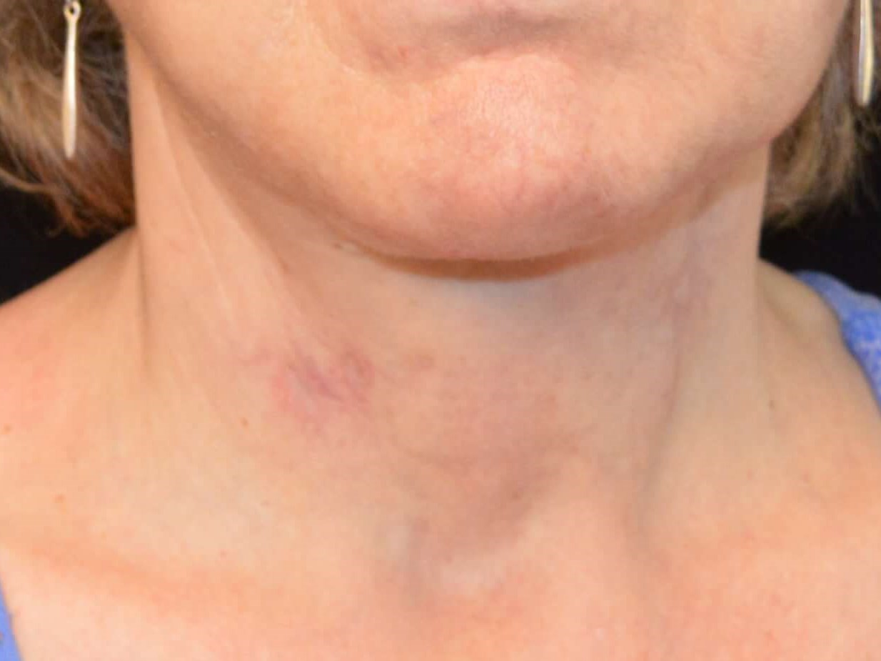 Before and After After