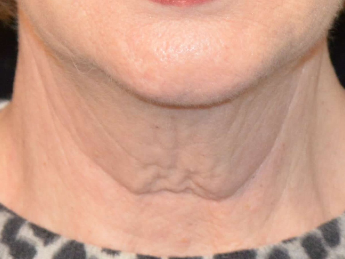 Before and After Before