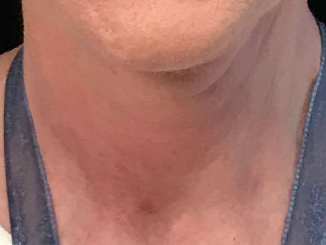 Before and After After