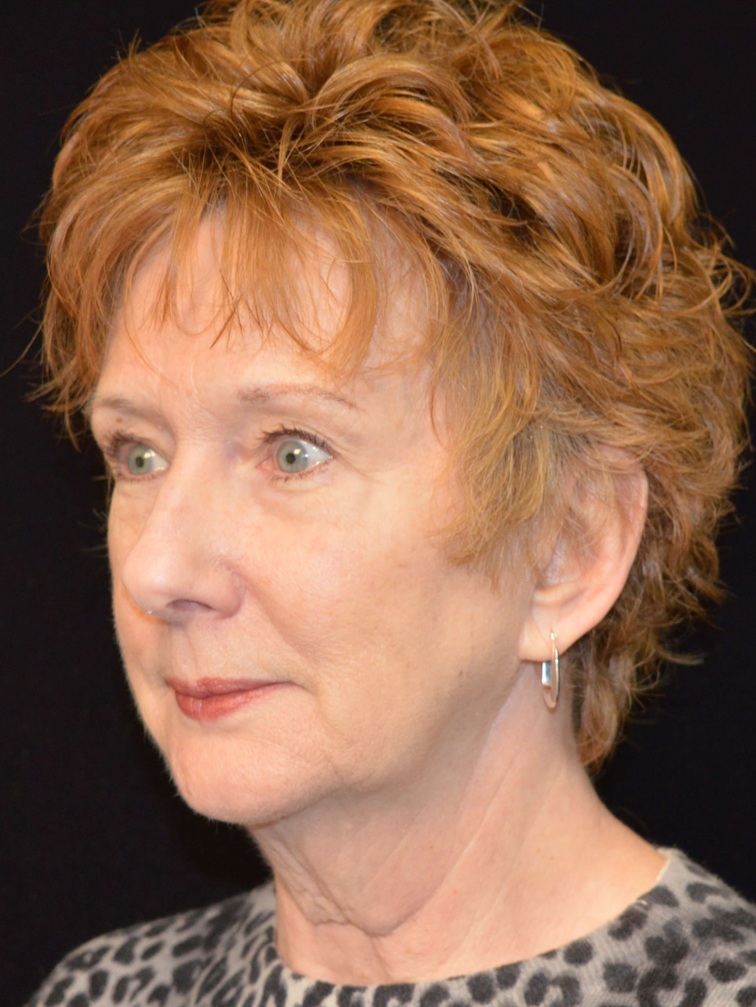 Before and After Before