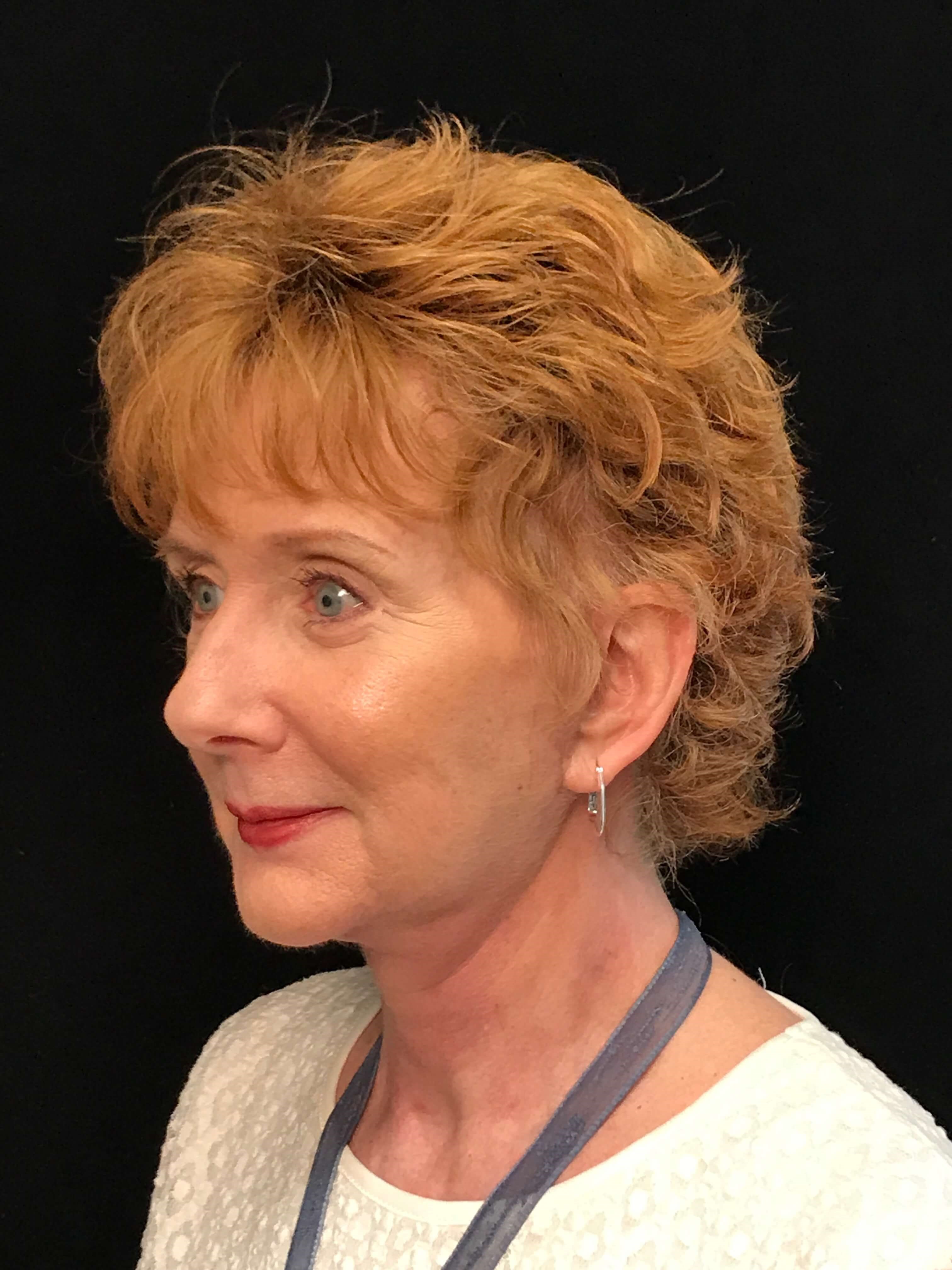 Before and After After