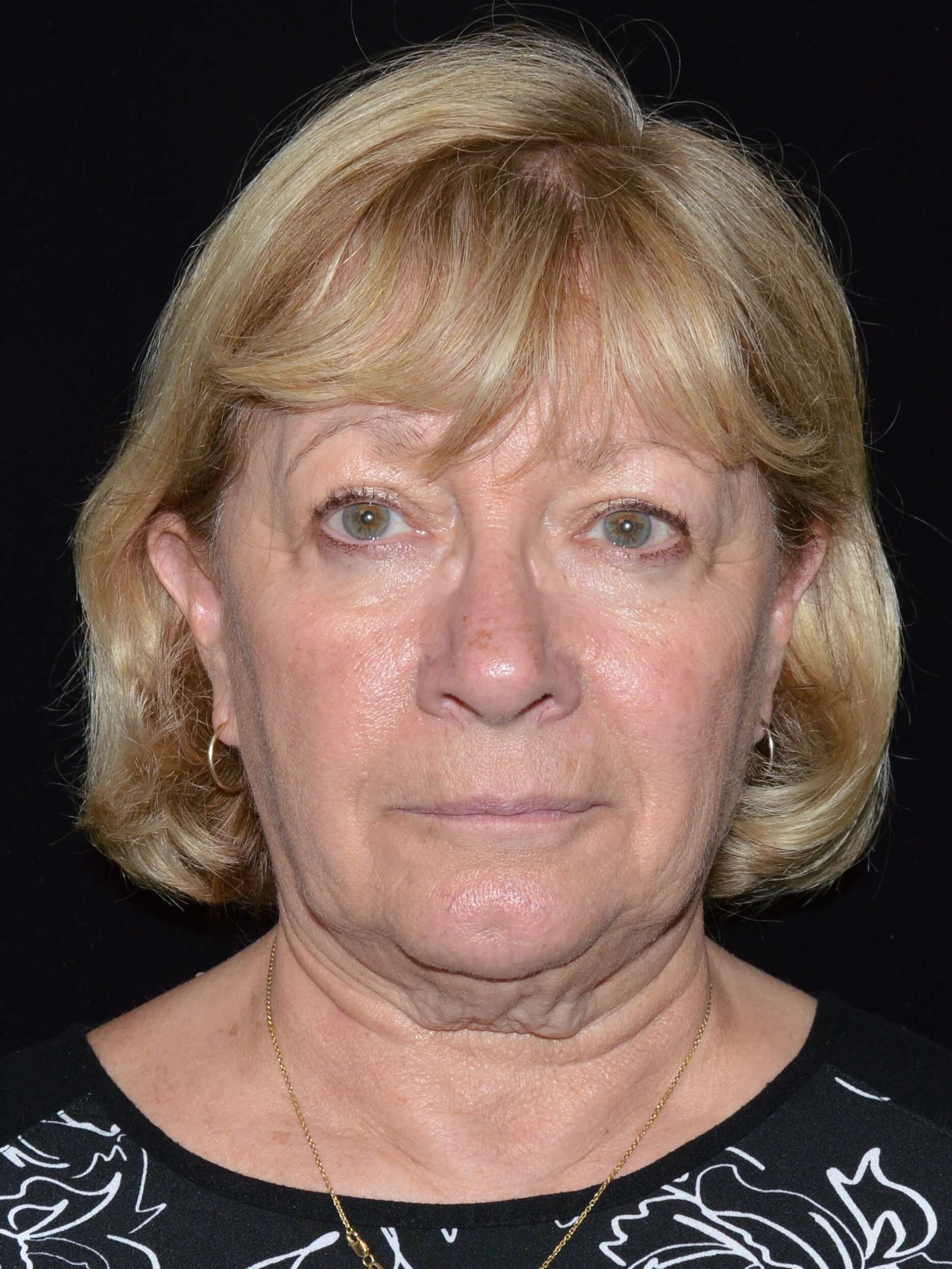 Before and After Before