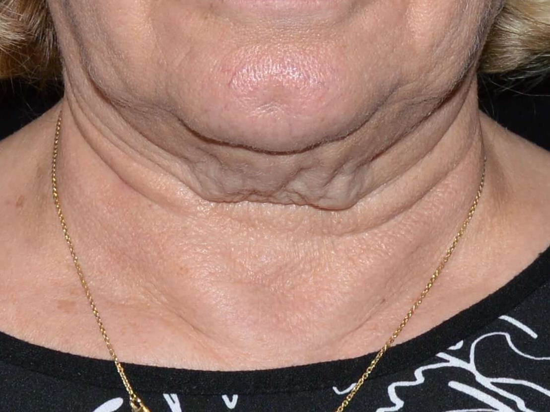 Before and After Before