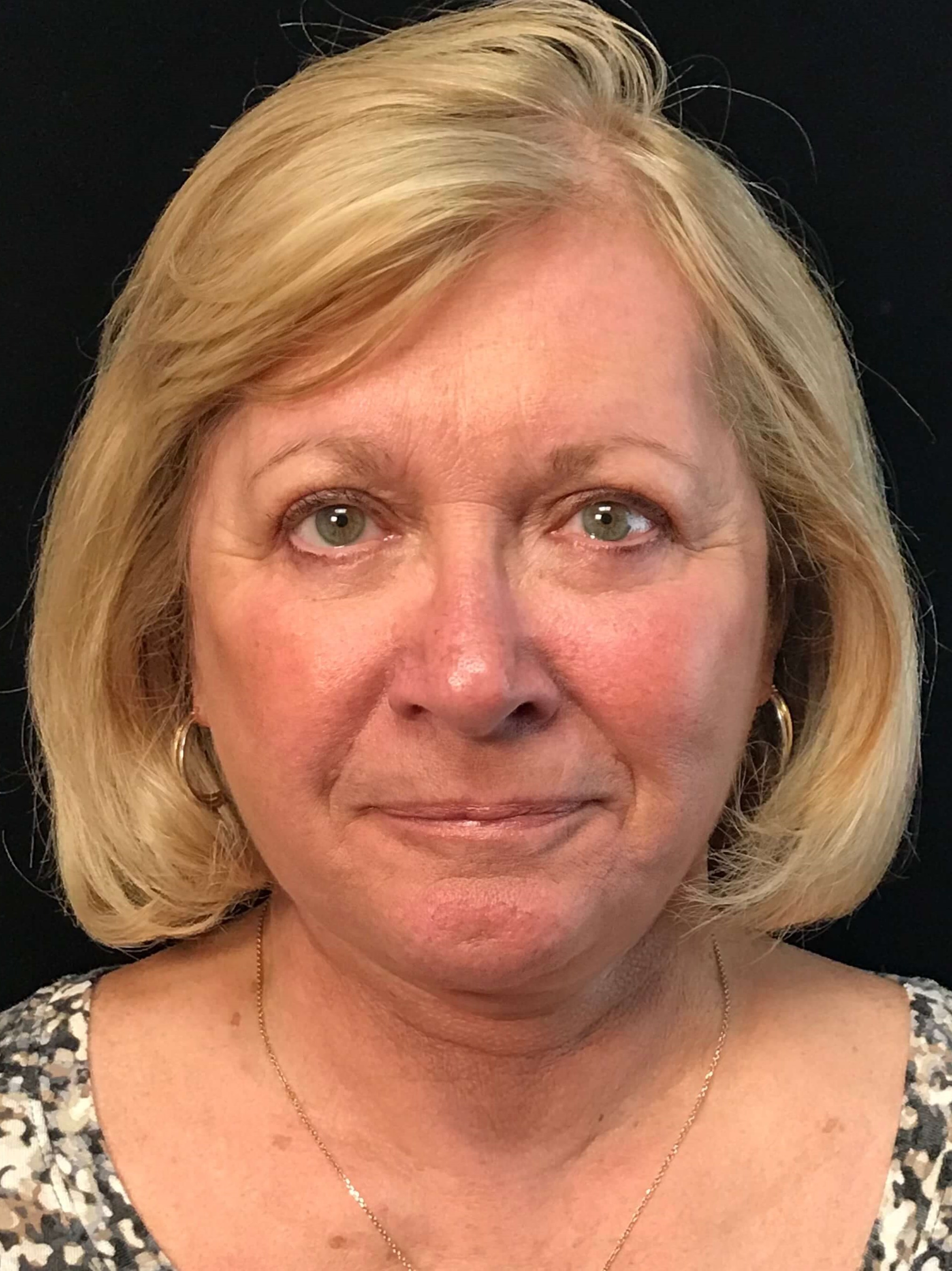 Before and After After