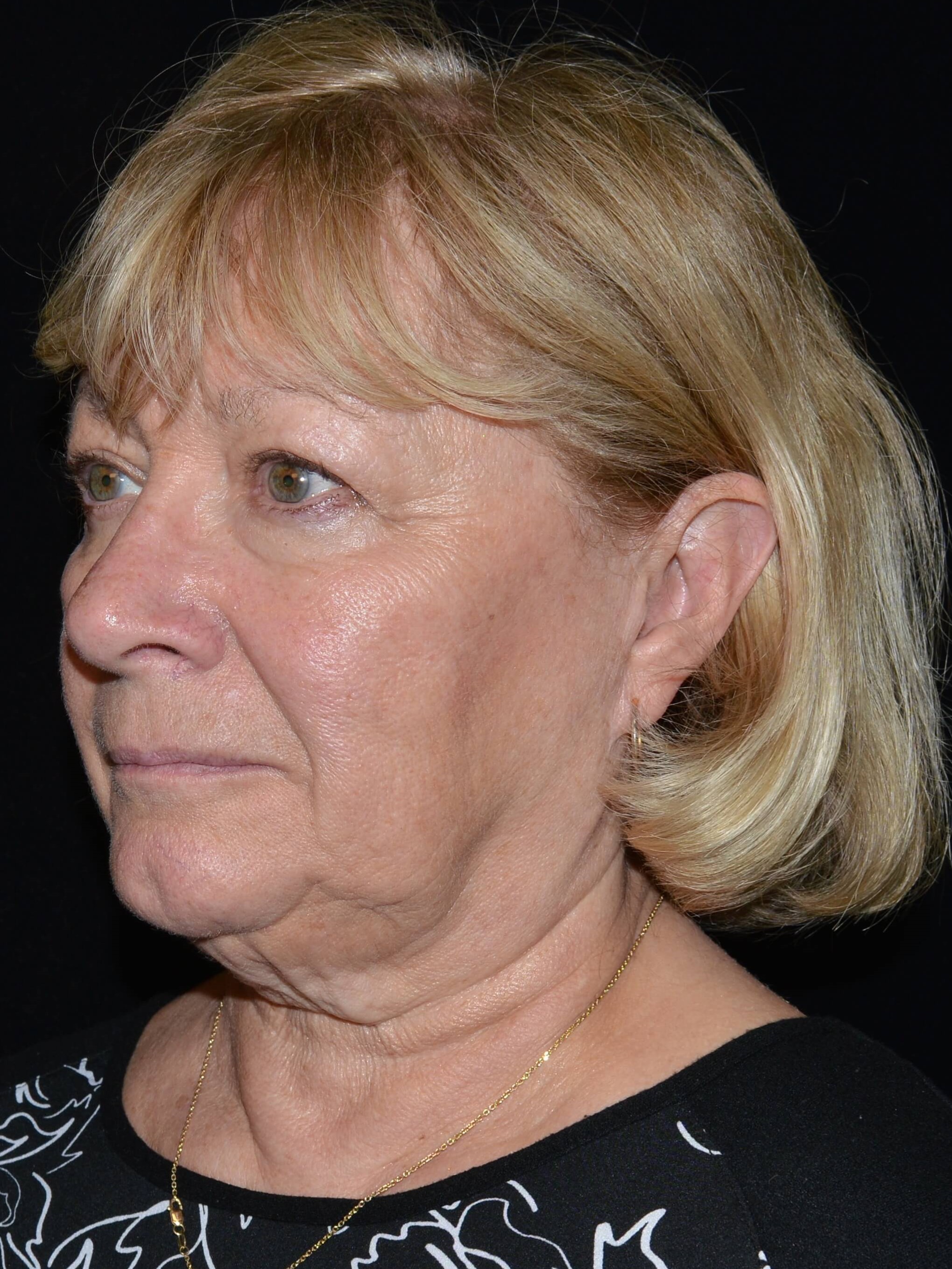 Before and After Before