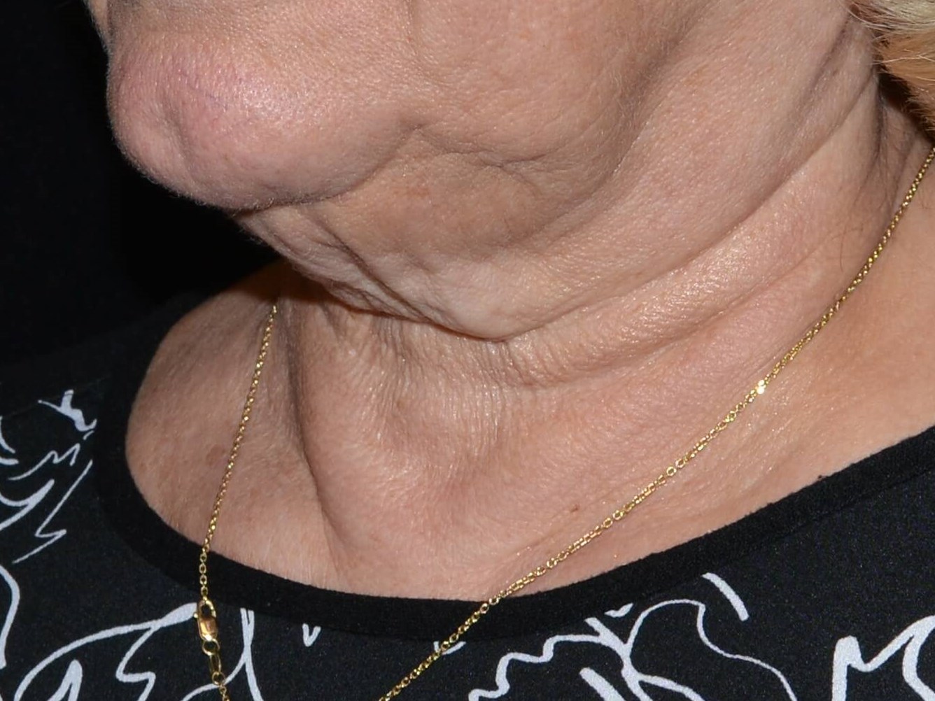 Before and After Before