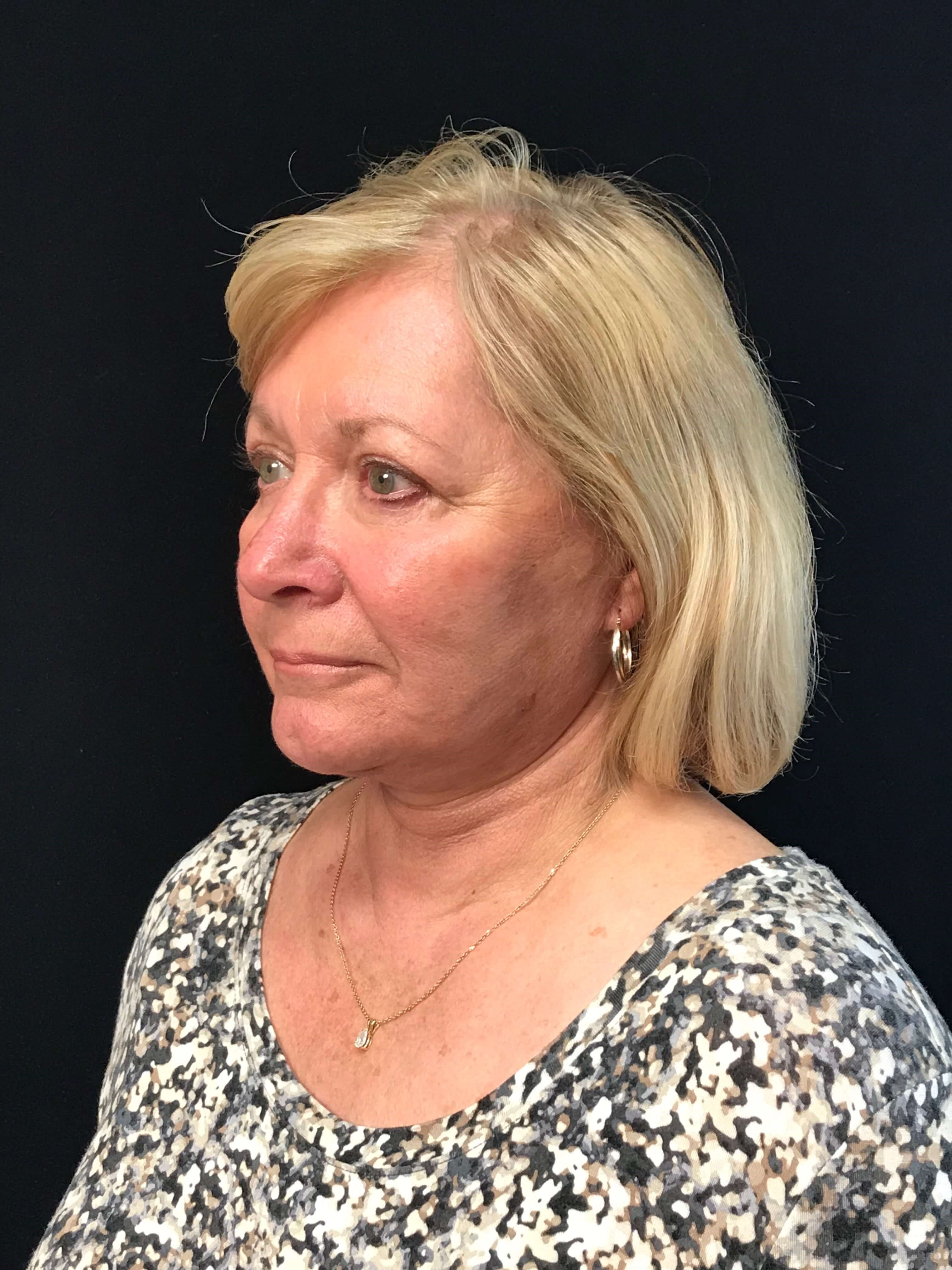 Before and After After