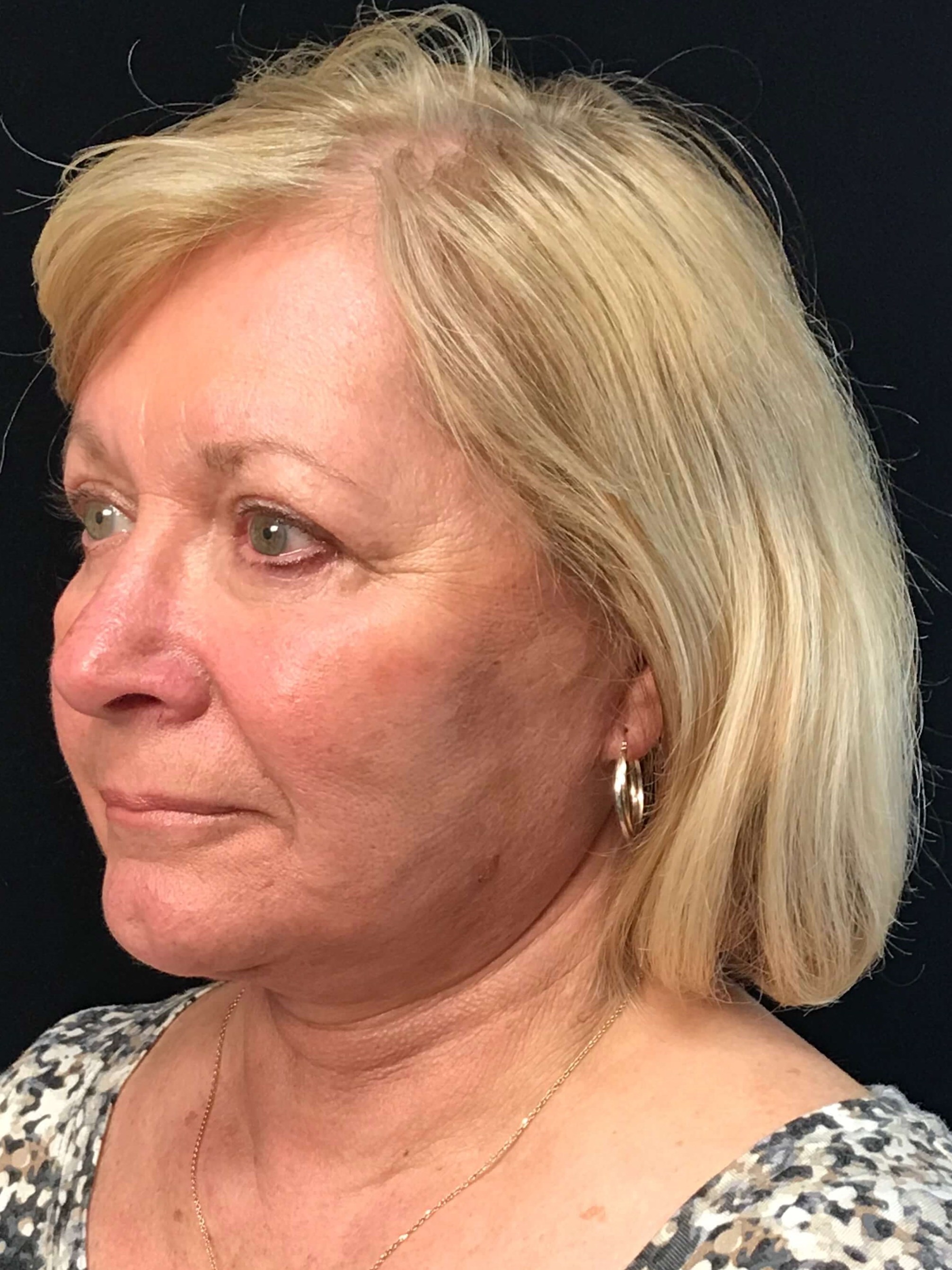 Before and After After