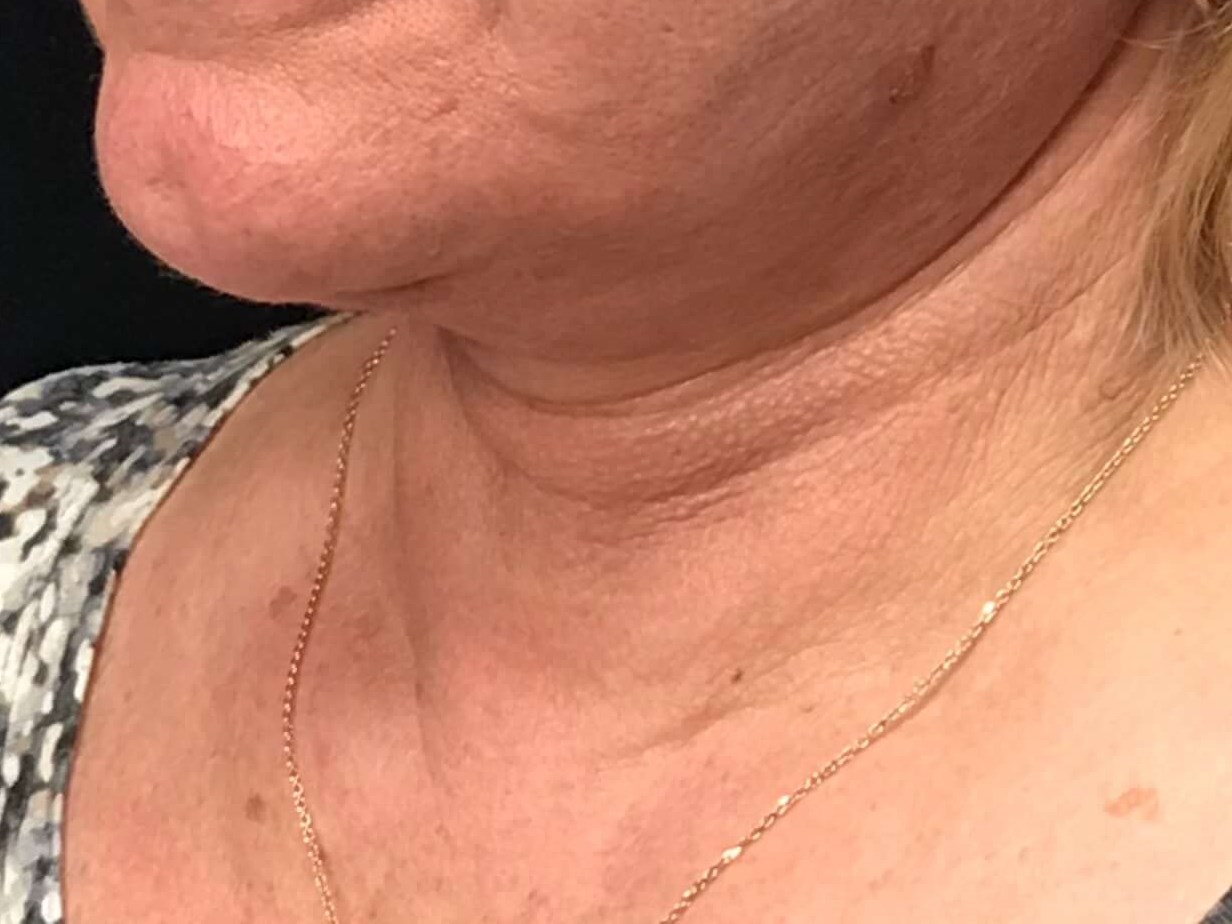 Before and After After