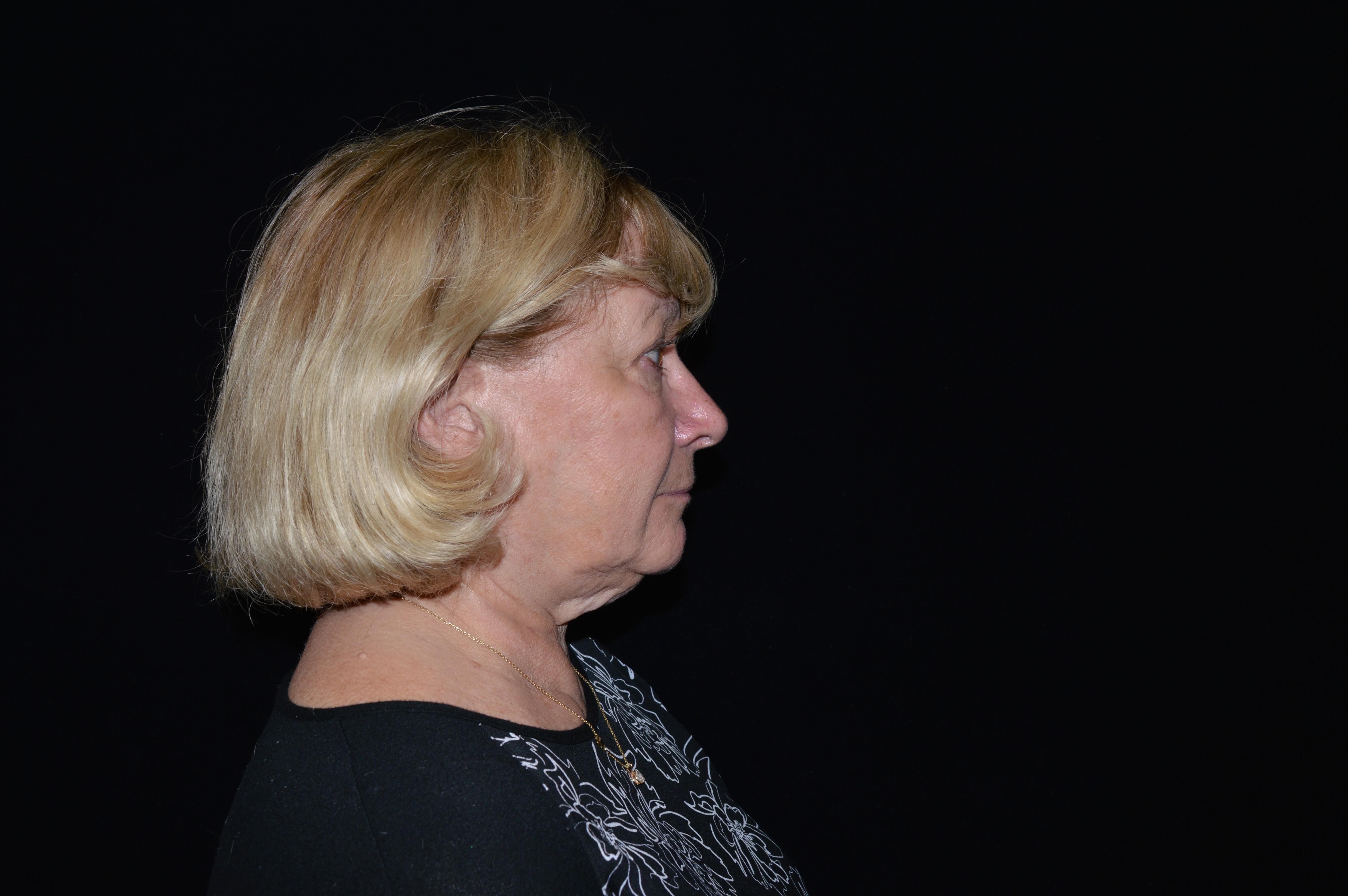 Before and After Before