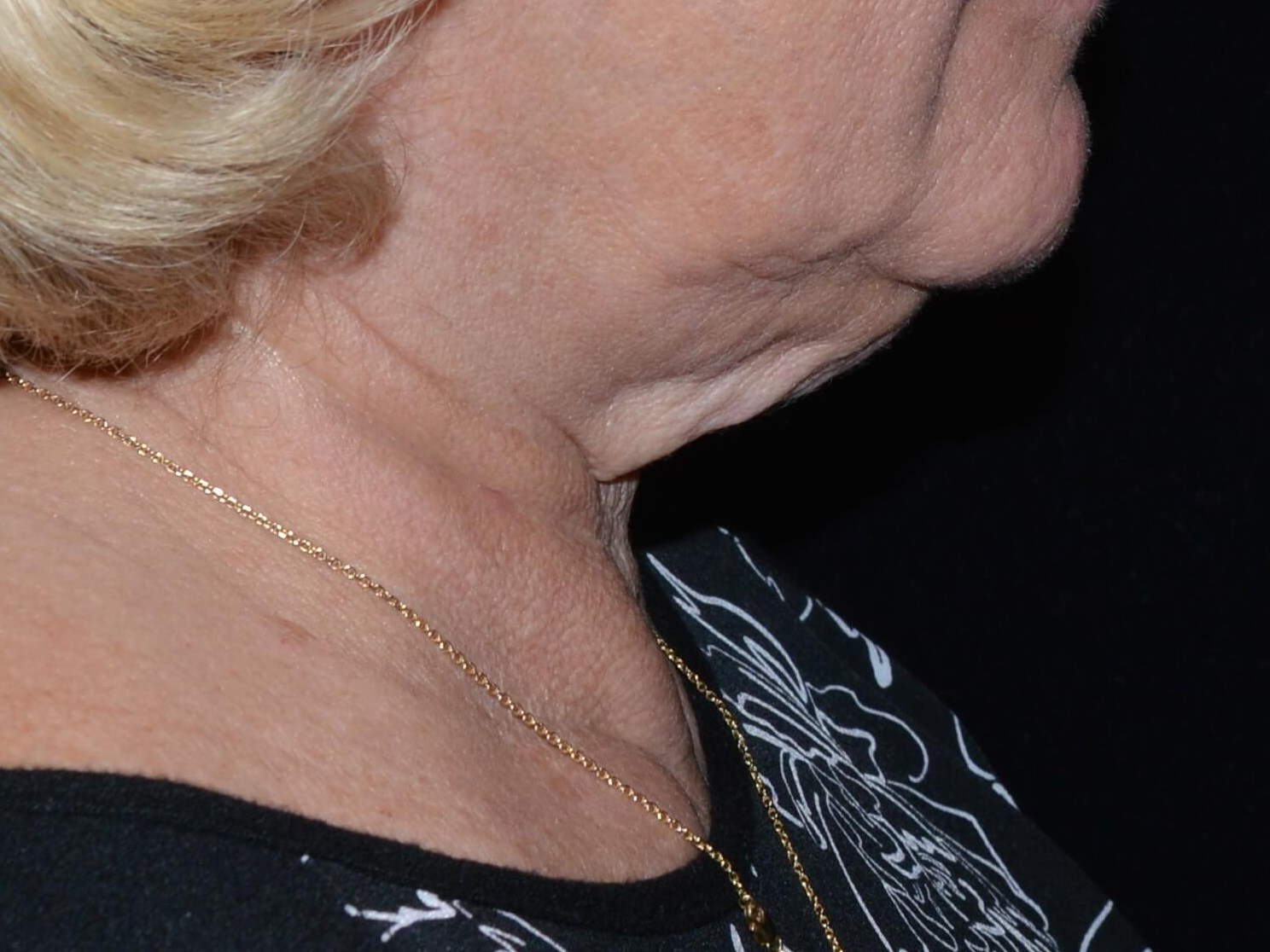 Before and After Before