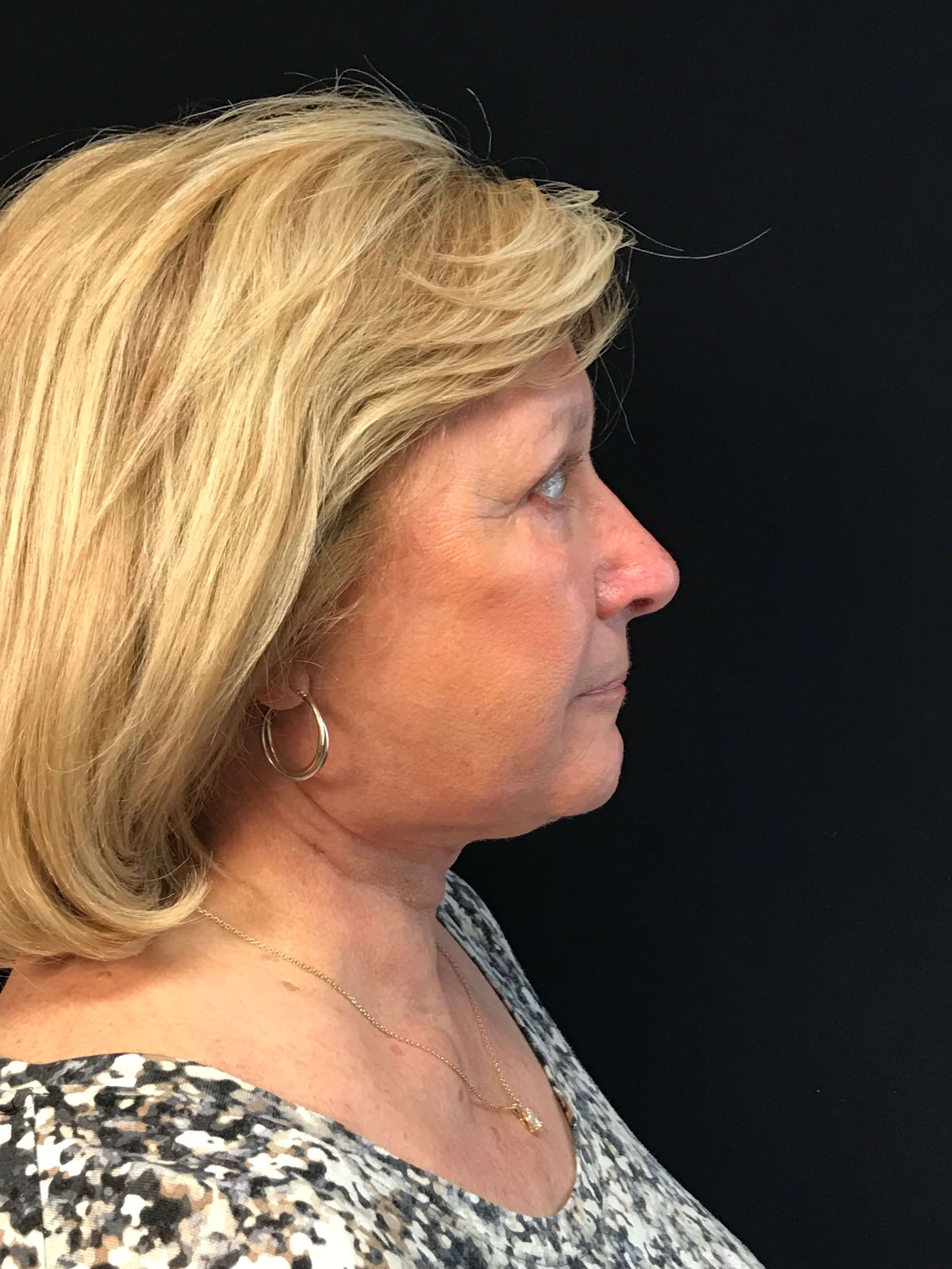 Before and After After