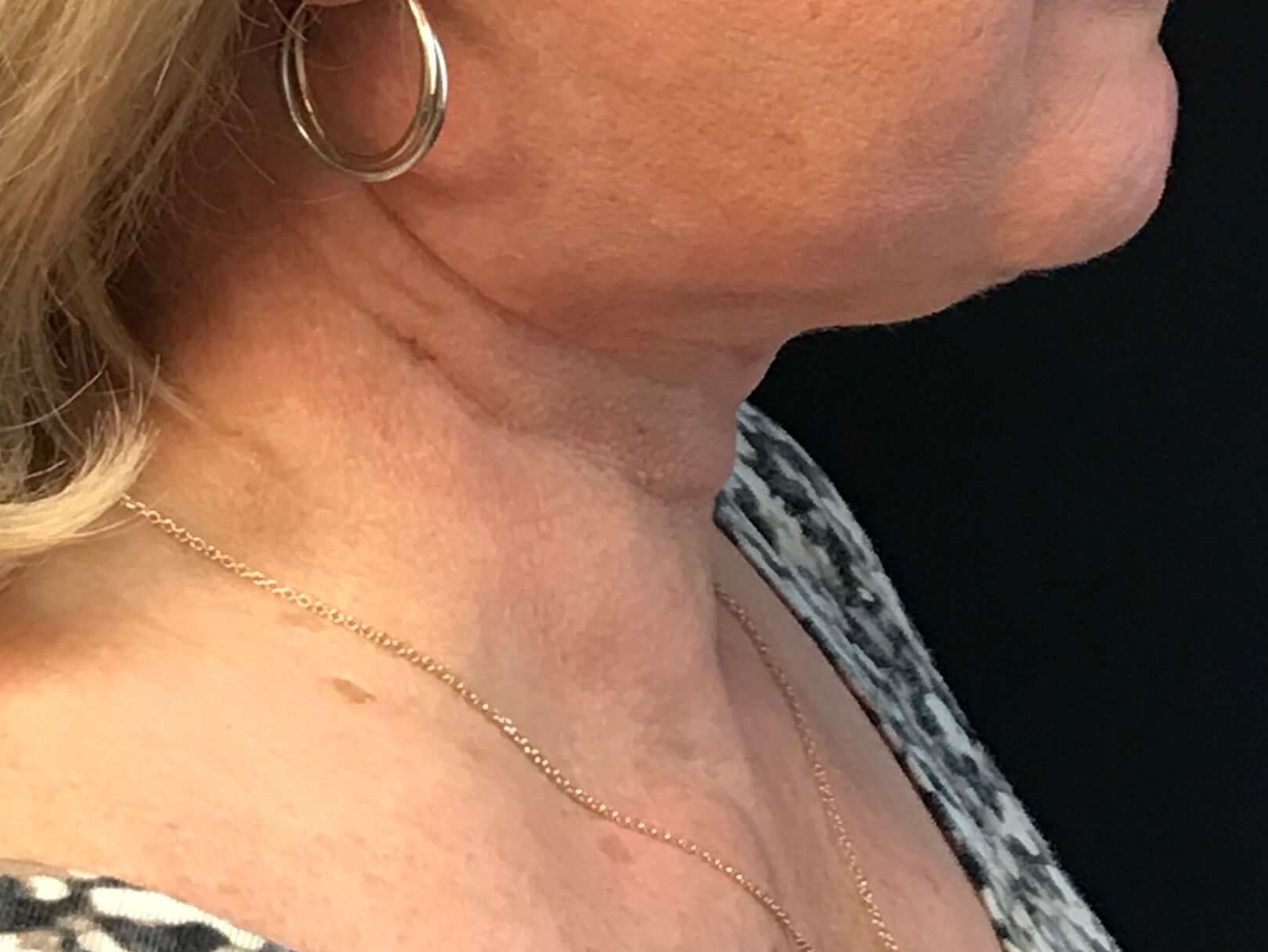 Before and After After