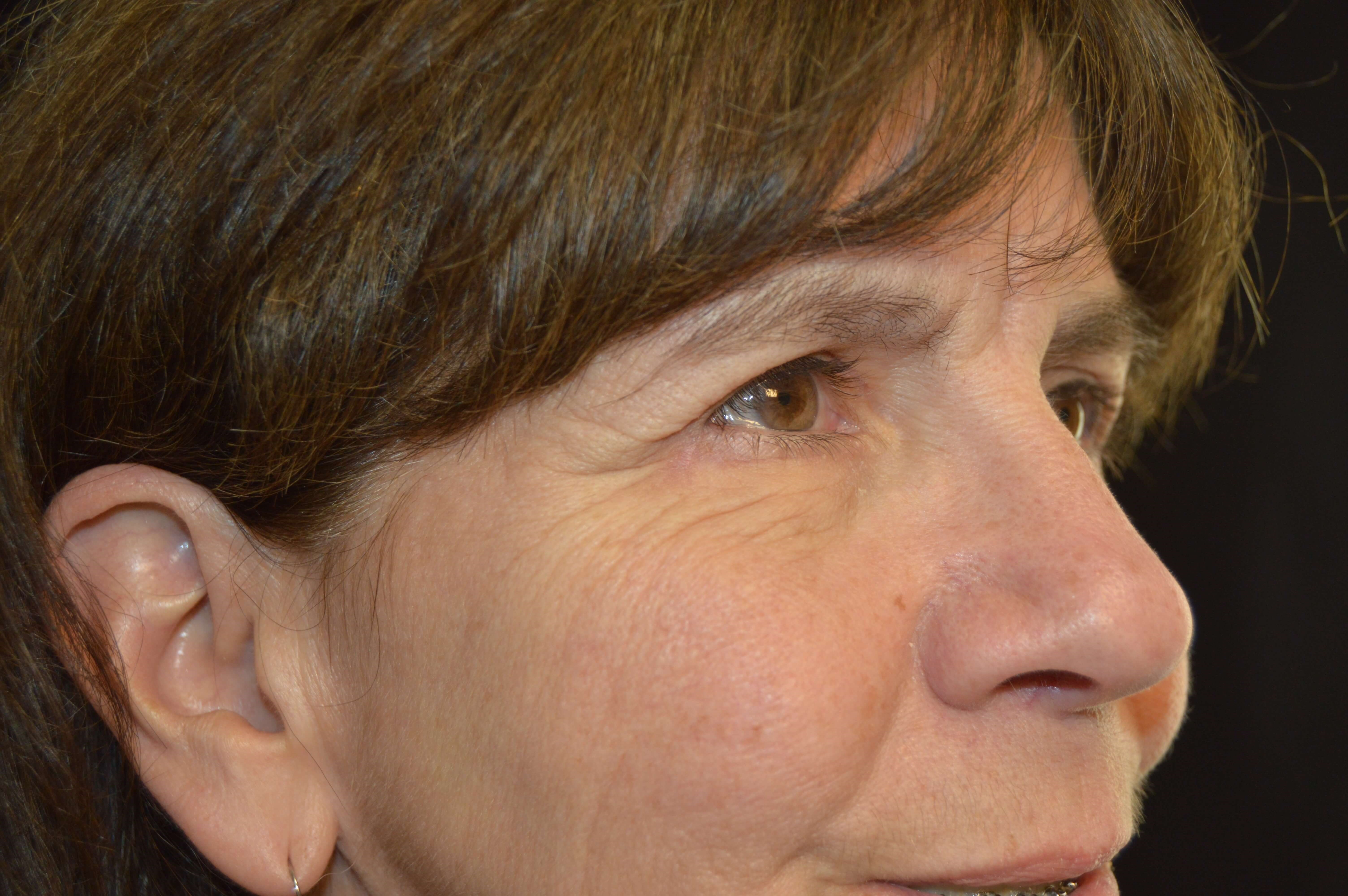 Before and After After