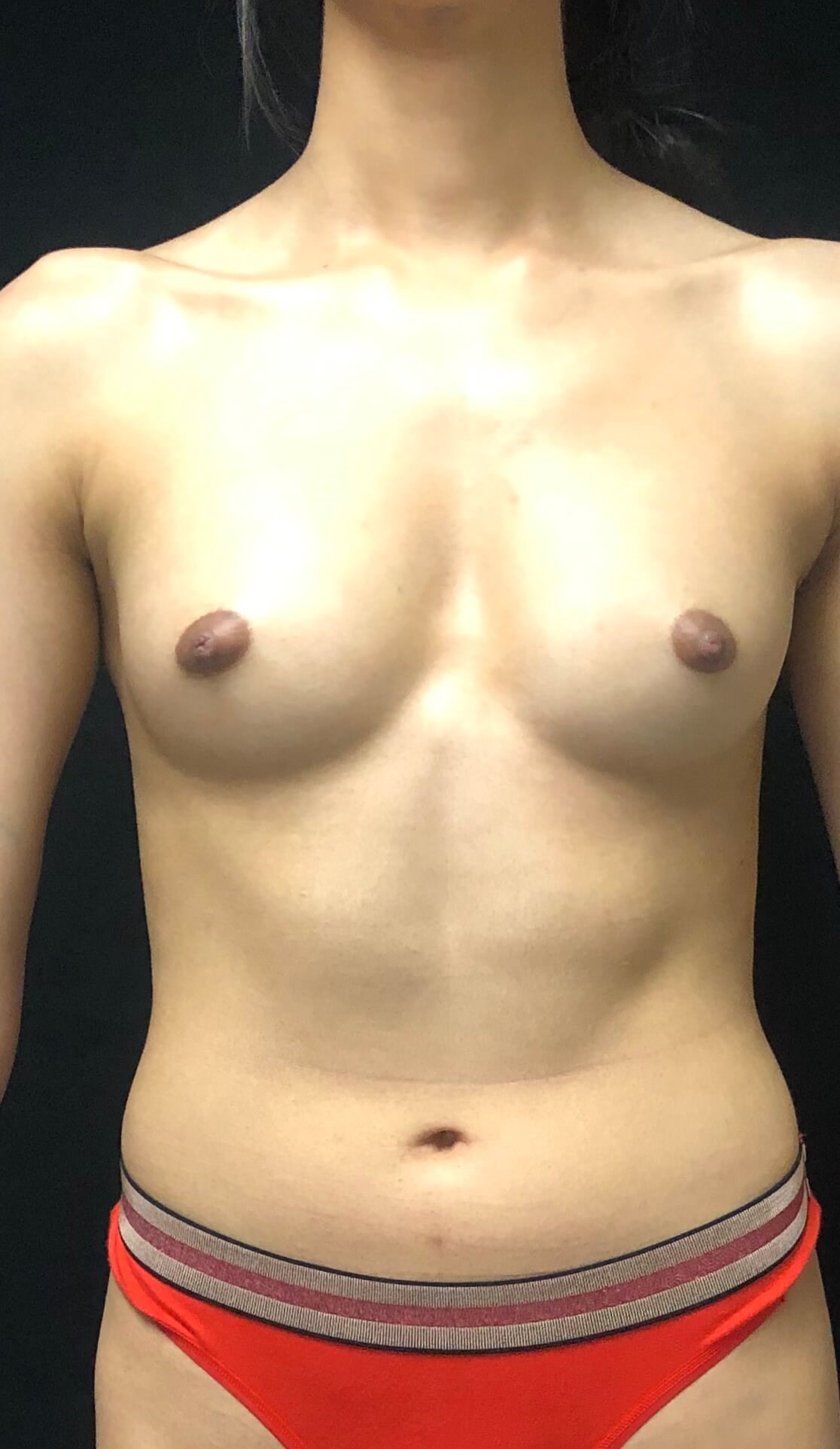 Breast Augmentation Before