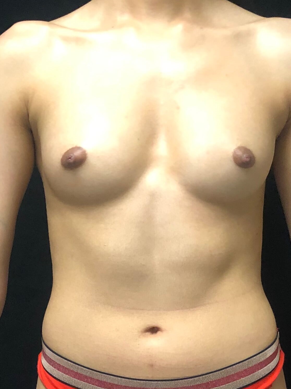 Breast Augmentation Before