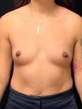 Breast Augmentation Before