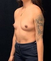 Breast Augmentation Before