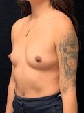 Breast Augmentation Before