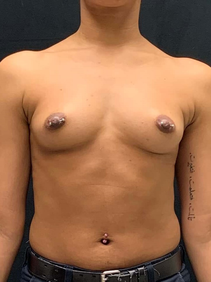 Breast Augmentation Before