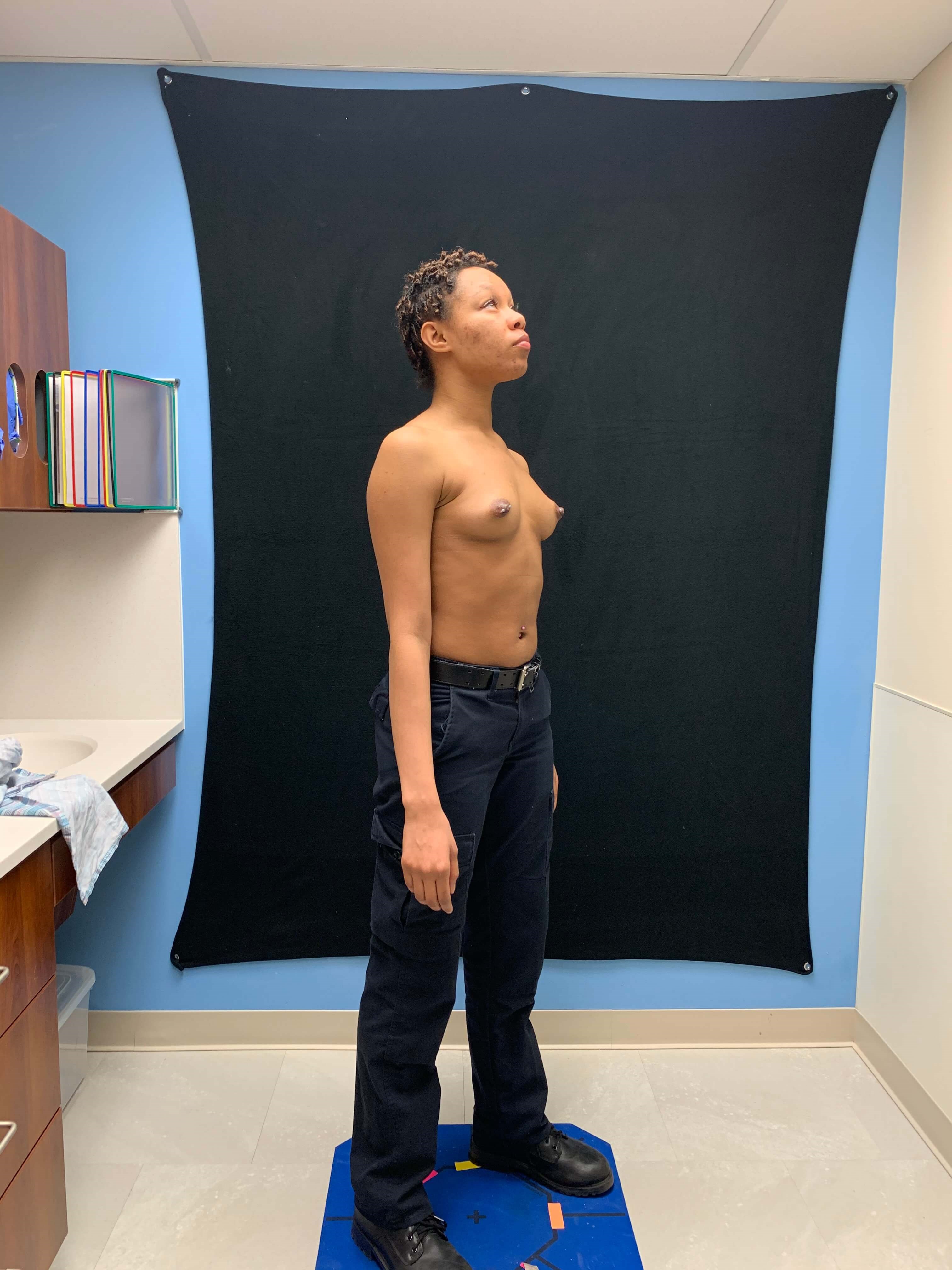 Breast Augmentation Before