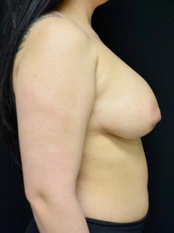 Breast Lift with Implants Before