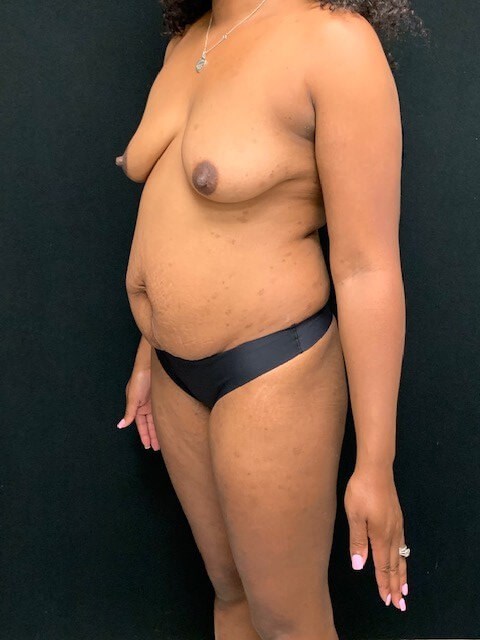 Tummy tuck / Abdominoplasty Before