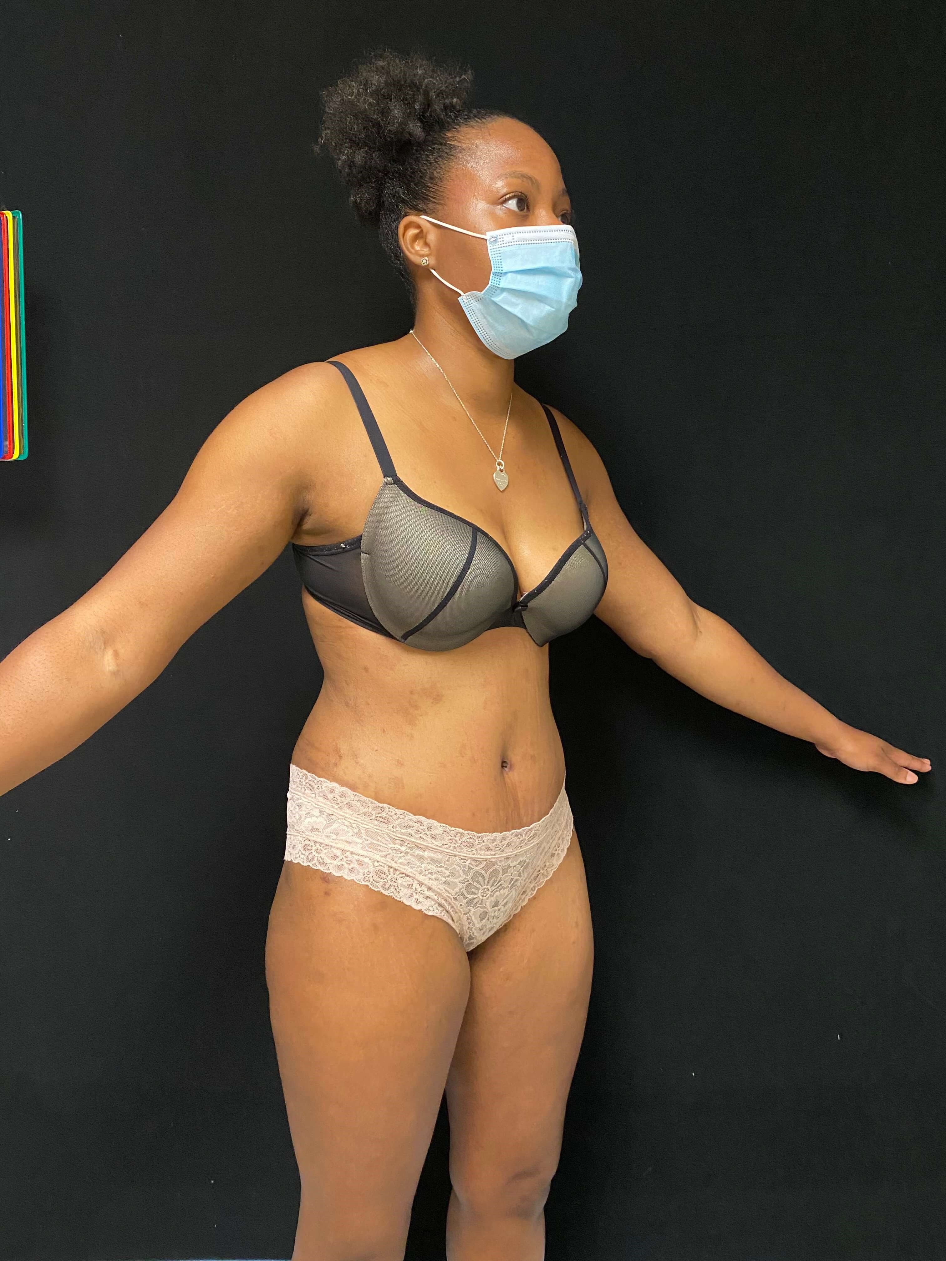 Liposuction / Abdominoplasty After