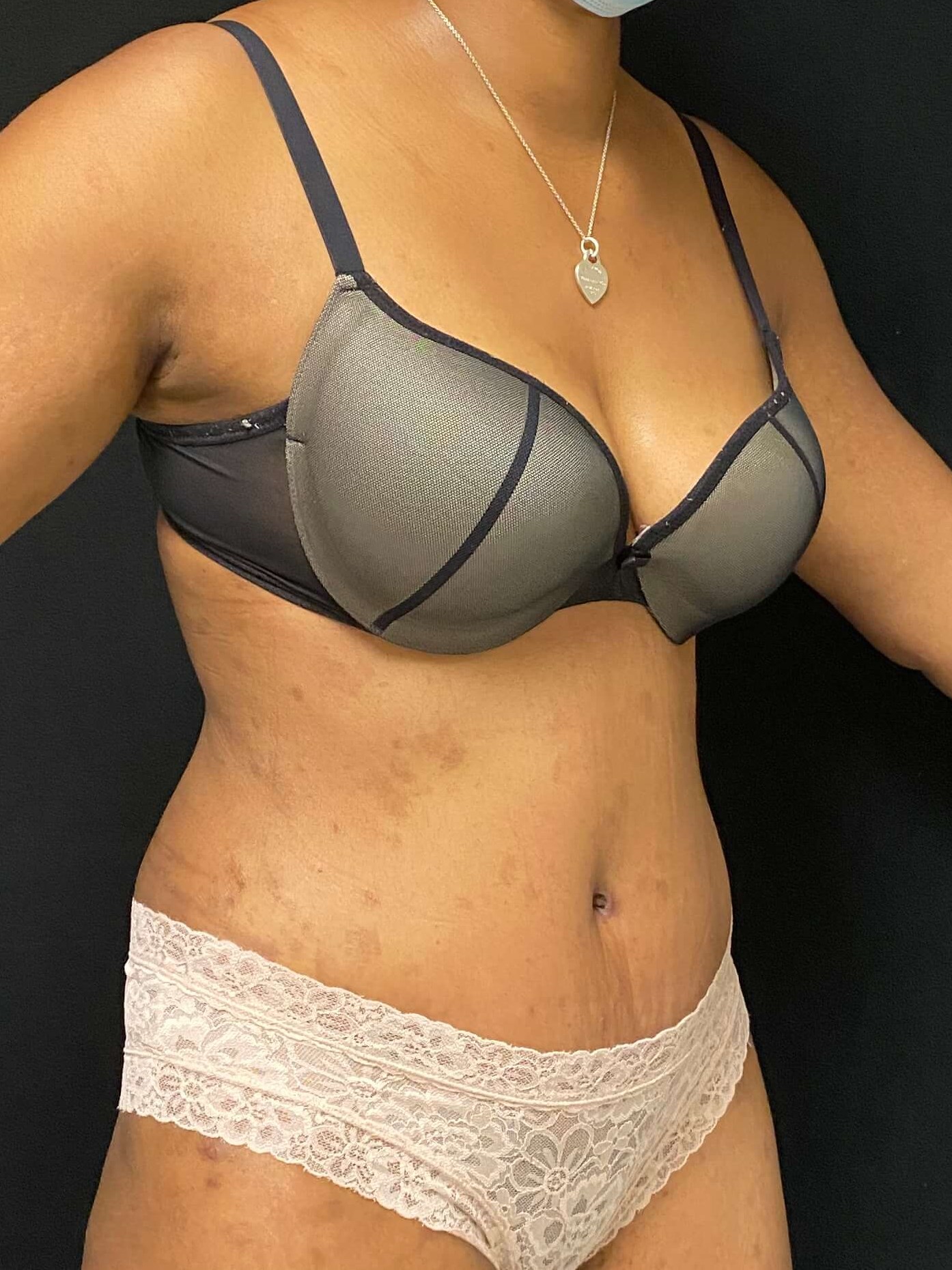 Liposuction / Abdominoplasty After