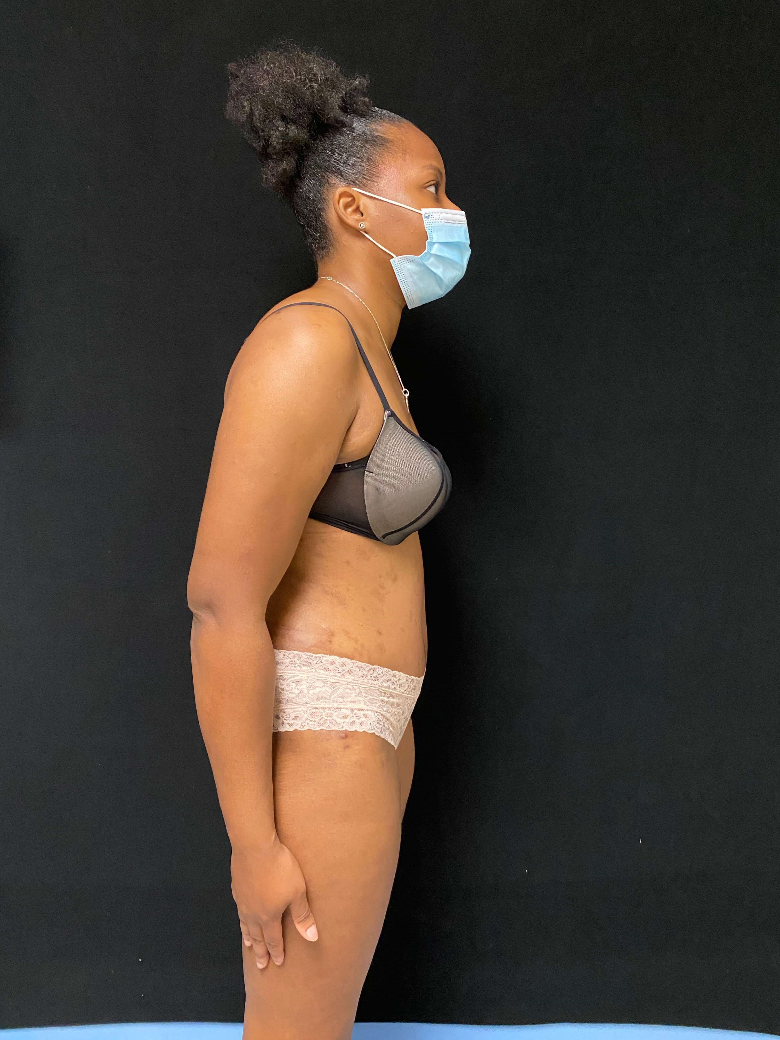 Liposuction / Liposculpture After