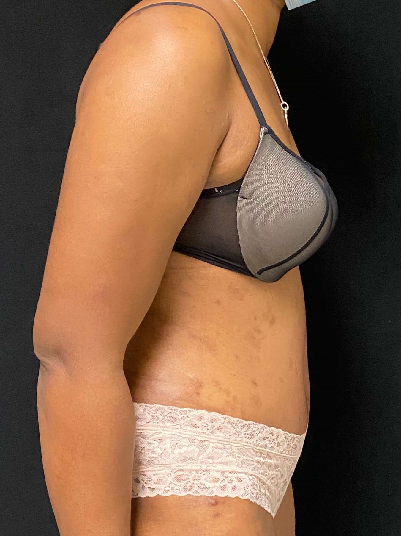 Liposuction / Liposculpture After