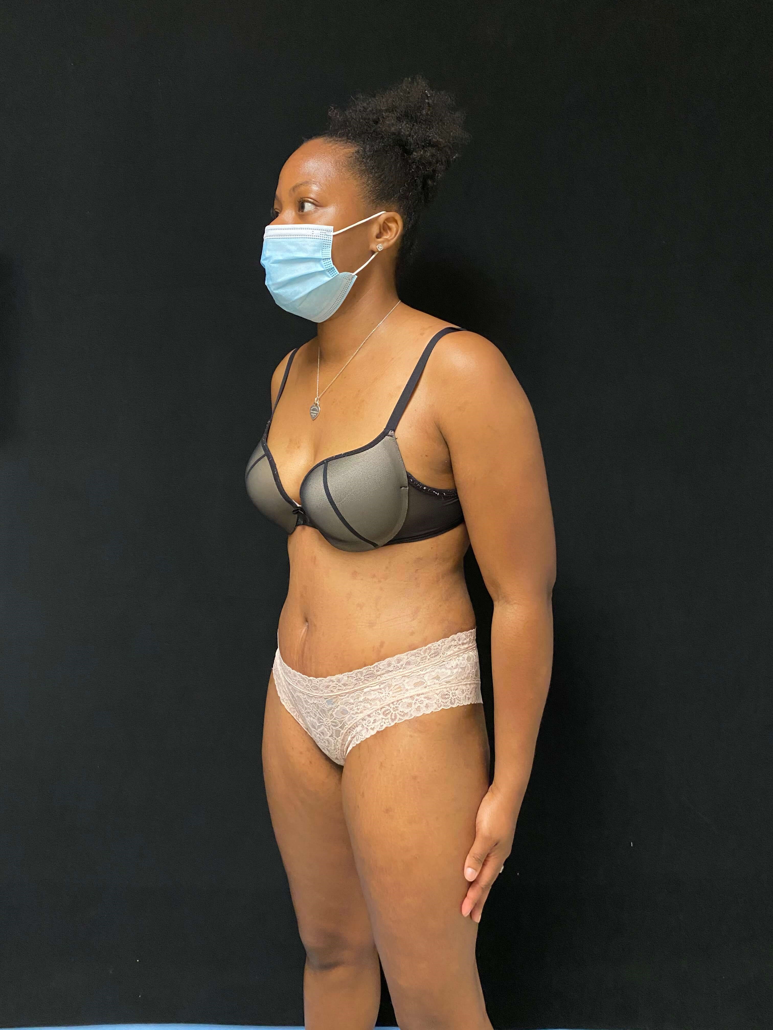 Tummy tuck / Abdominoplasty After