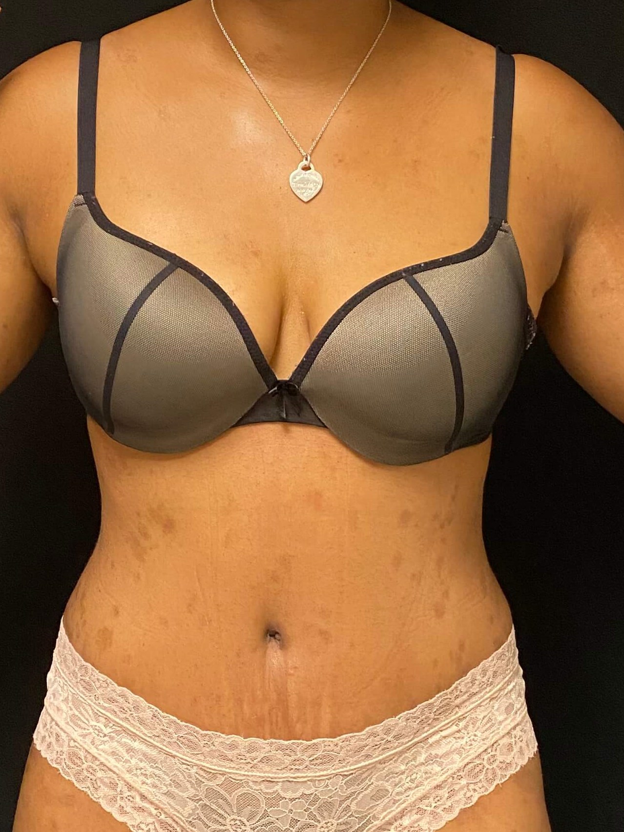 Abdominoplasty / Tummy Tuck After